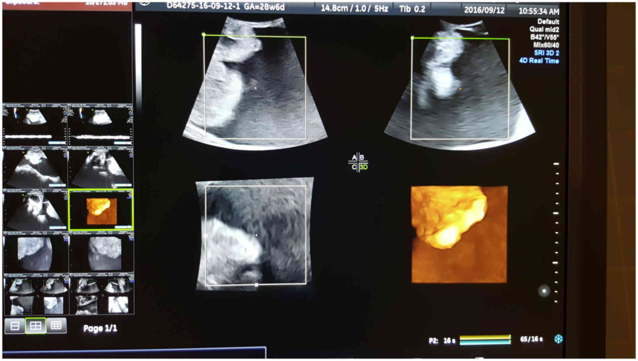 peritoneal cancer while pregnant