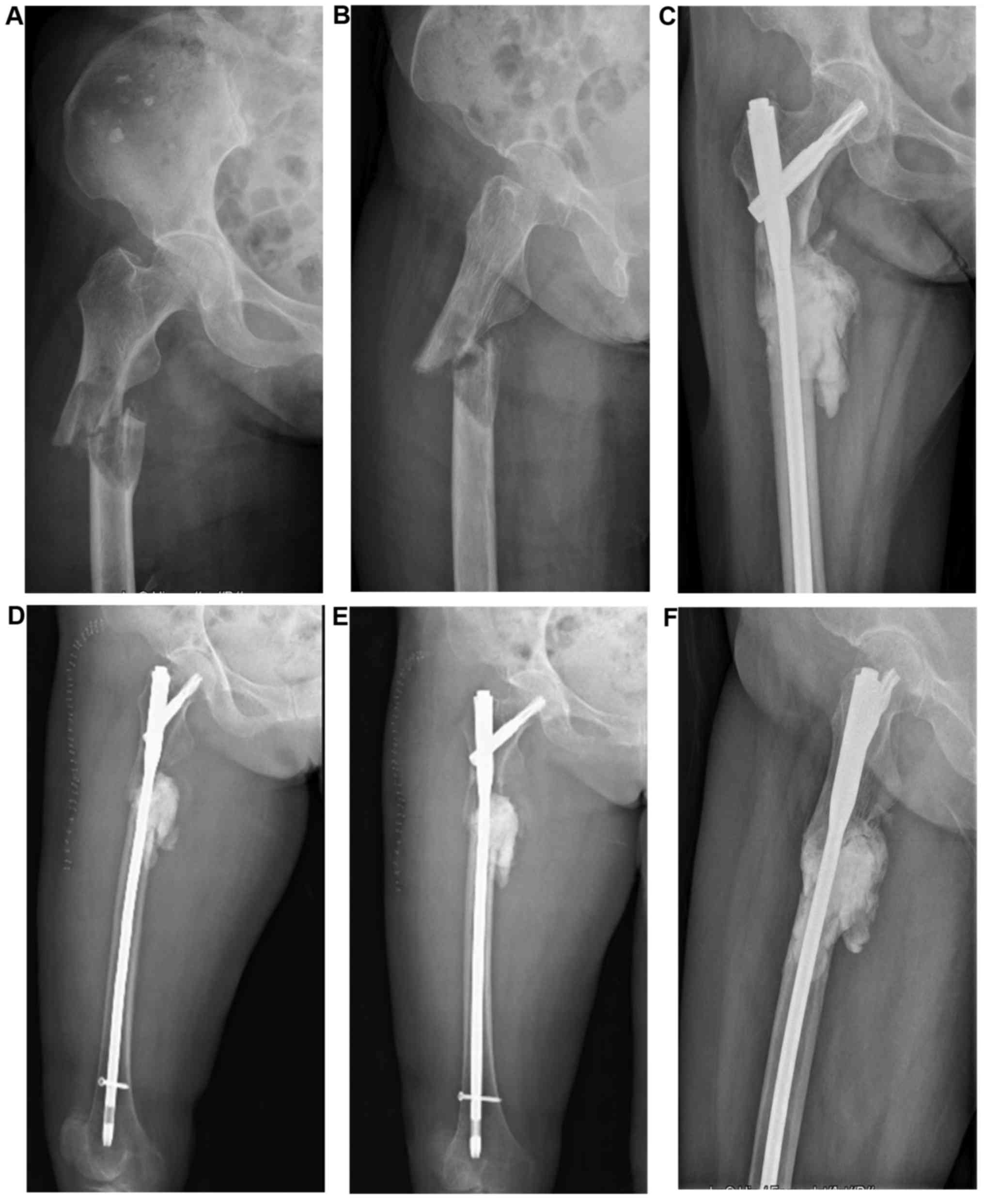 Figure 3 from Radiographic Outcomes of Osteosynthesis Using Proximal  Femoral Nail Antirotation (PFNA) System in Intertrochanteric Femoral  Fracture: Has PFNA II Solved All the Problems? | Semantic Scholar
