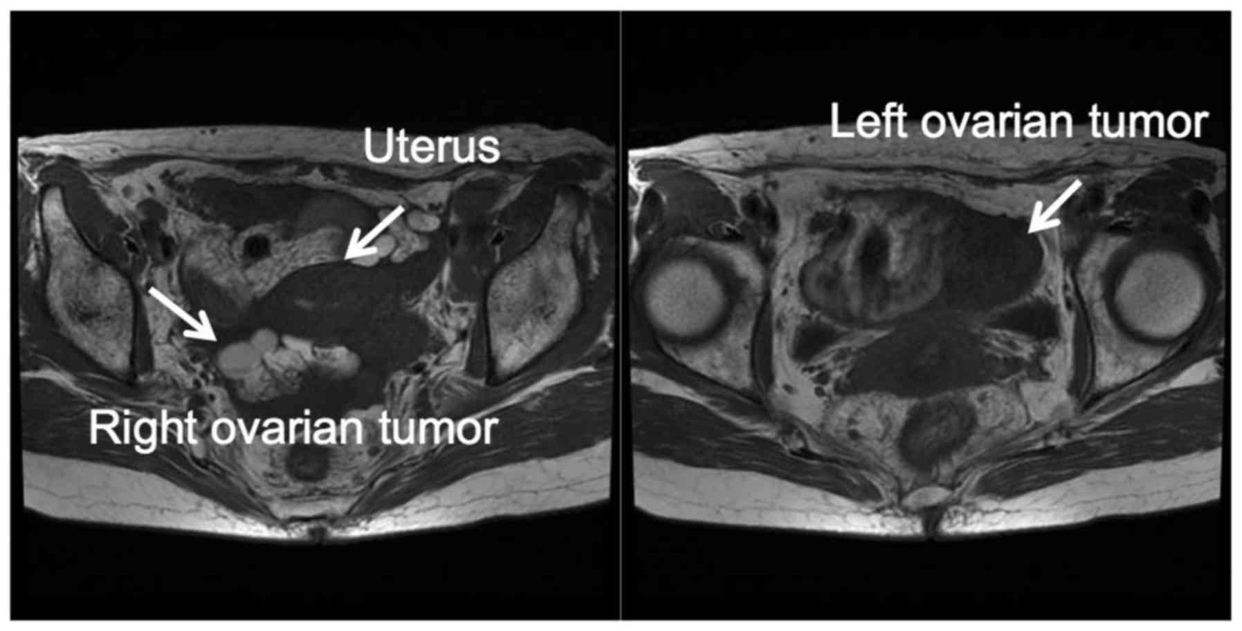 Cancer risk abdominal ct scan, Ovarian cancer on ct scan - Ovarian cancer ct scan