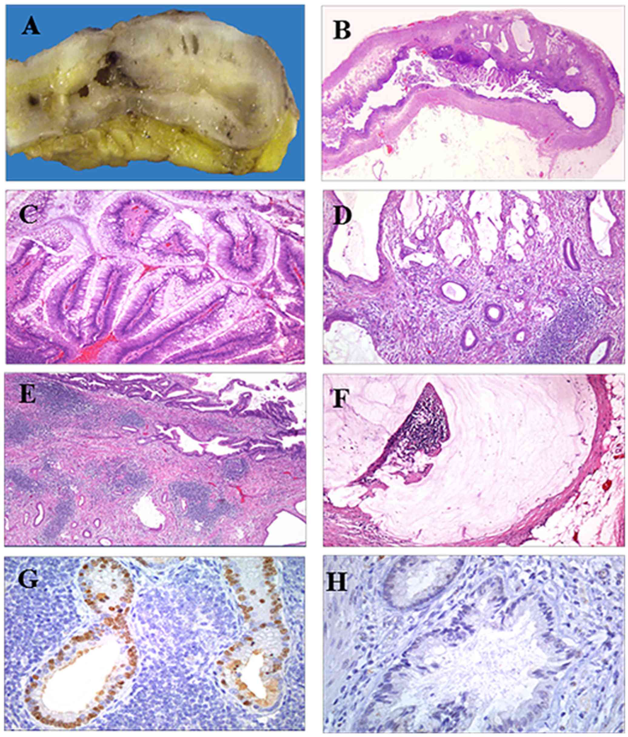 Papiloma intraductal histologia - Papiloma ductal seram
