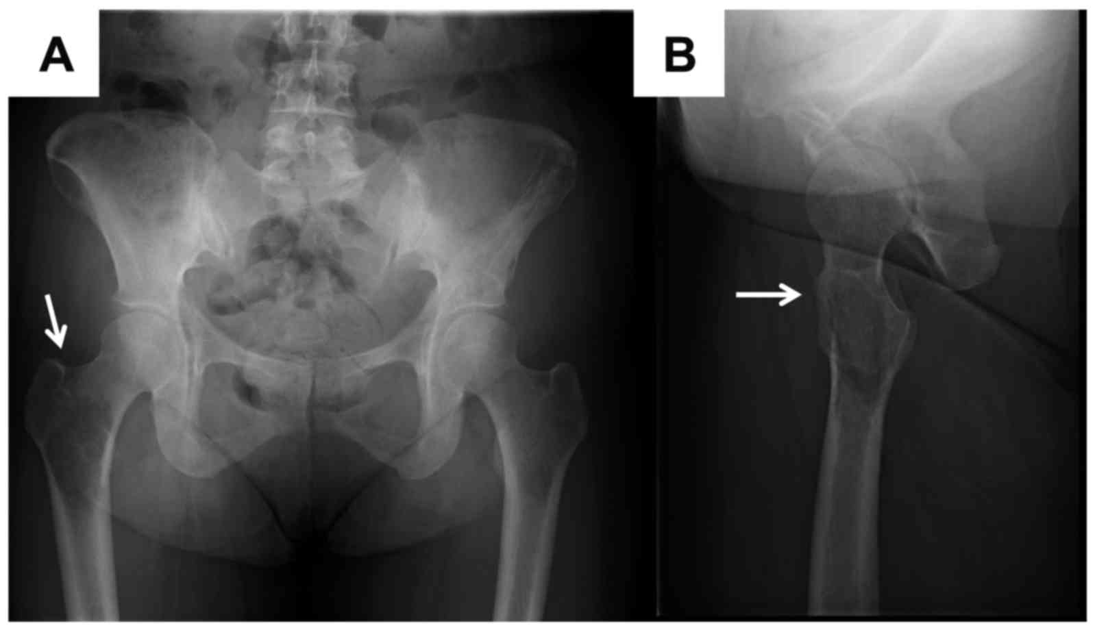 Трещина пациент. Subtrochentric Fracture of femur x ray. Trochanter Major Entesopathy чкфн.
