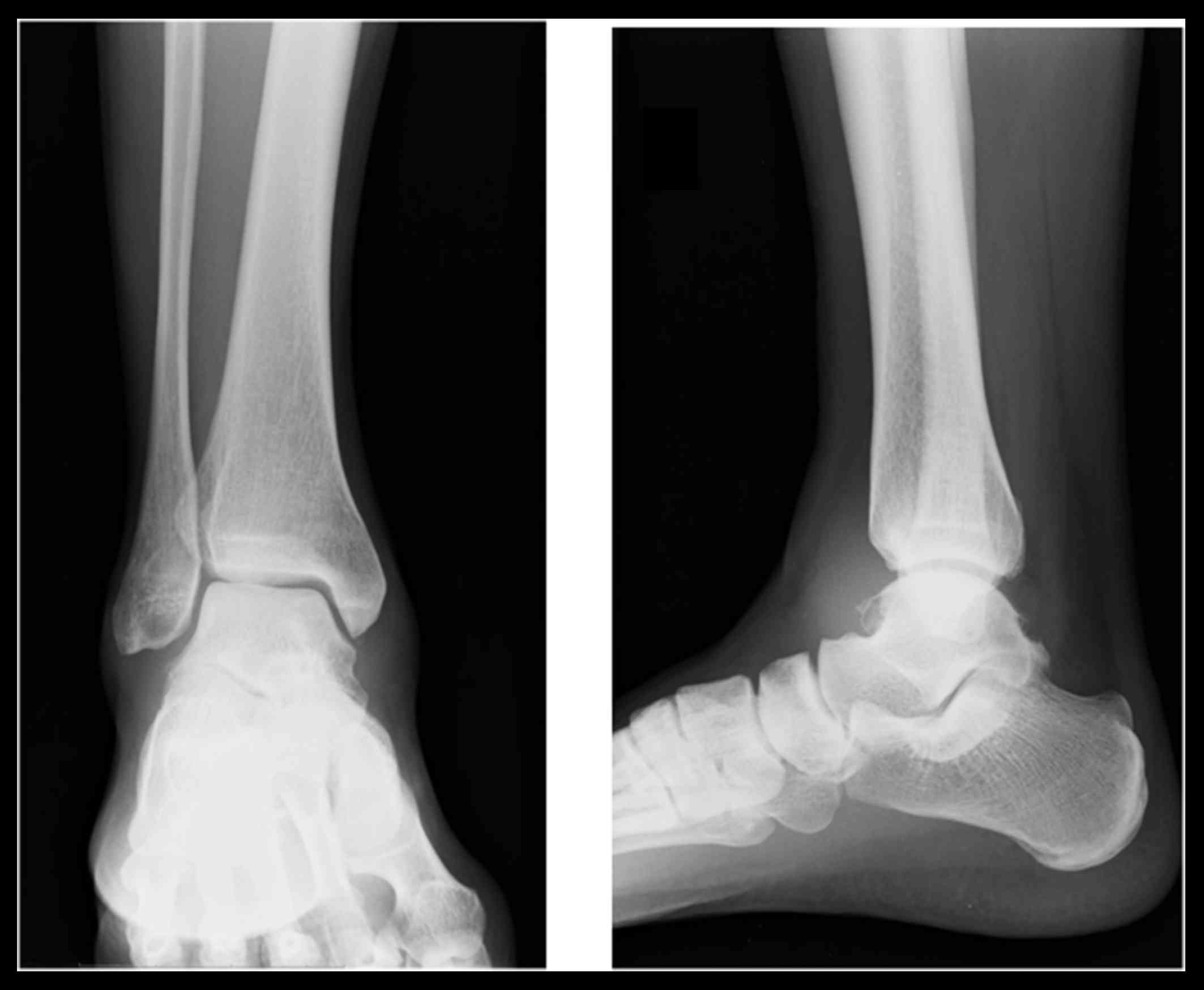 sarcoma cancer in ankle
