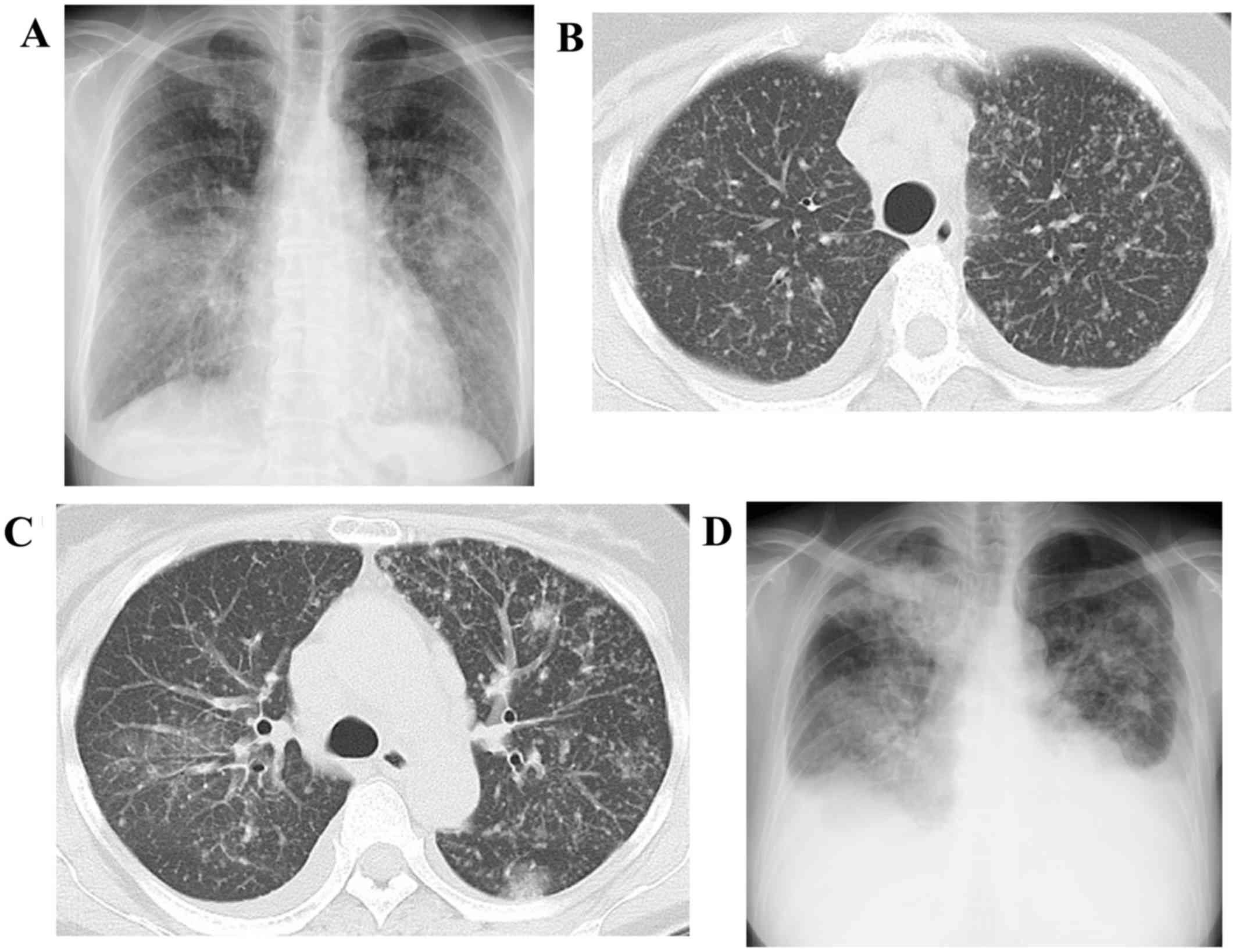 Miliary lung metastases from non‑small cell lung cancer with Exon 20 ...