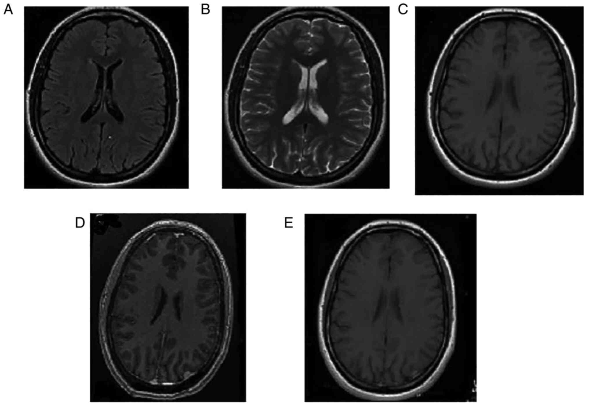 Uncommon and atypical meningiomas and imaging variants: A report of 7 cases