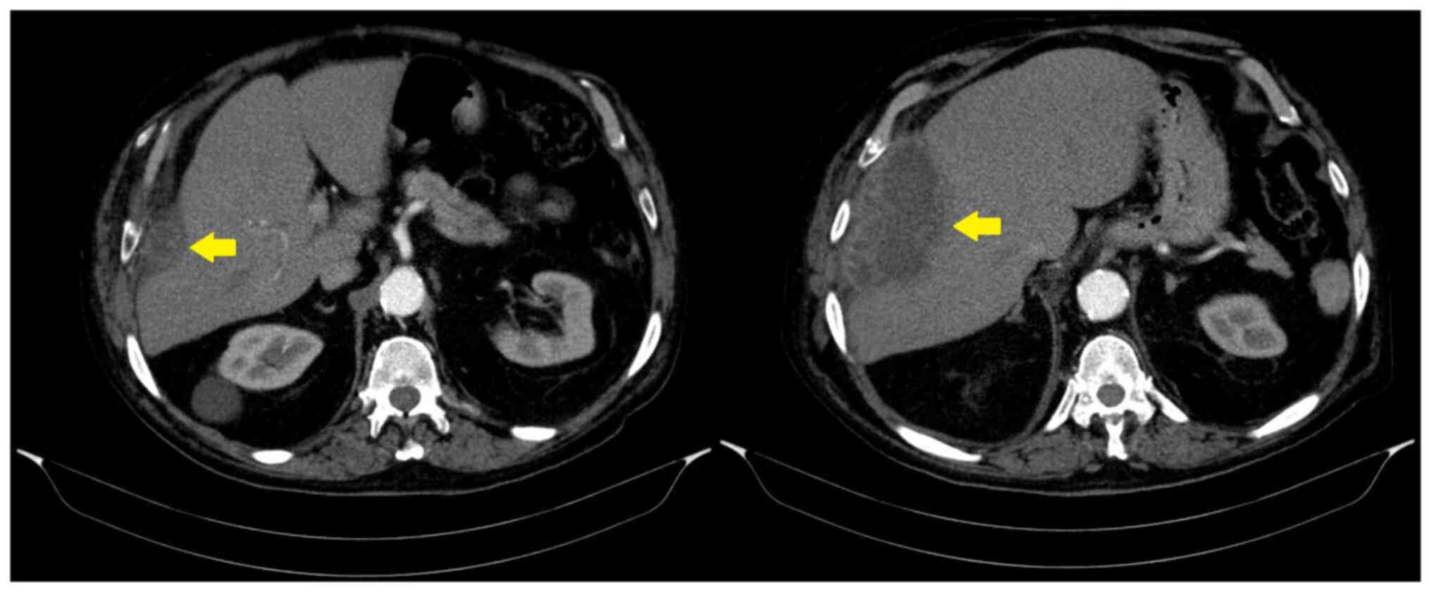 Computed tomography images
illustrating a complex cystic mass measuring 11.5 cm in diameter,
located in the right subdiaphragmatic region, extending into the
thoracic soft tissue at the 7th and 8th intercostal spaces. The
mass involved the right pleura and middle lobe of the lung,
exerting compressive effects on the right liver lobe. Atelectasis
was observed in the lower and middle lobes of the right lung and
the lower lobe of the left lung. A small right-sided pleural
effusion was also noted. The image on the left panel represents the
upper axial slice, illustrating the superior aspect of the
subdiaphragmatic abscess. The image on the right panel represents
the lower axial slice, providing clearer visualization of the
caudal extent of the abscess. Yellow arrows indicate the abscess in
both images.