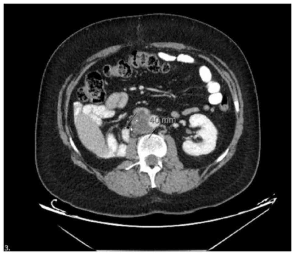 Computed tomography image of the
retroperitoneal mucinous adenocarcinoma lesion arising from a
teratoma. Contrast-enhanced axial CT image demonstrating a
heterogeneous retroperitoneal mass with cystic and solid
components, consistent with teratoma-derived adenocarcinoma
following chemotherapy for relapsed testicular germ cell tumor. In
this CT image, the tumor along with a 40-mm lymphadenopathy (LAP)
complex that was developed as a result can be observed.