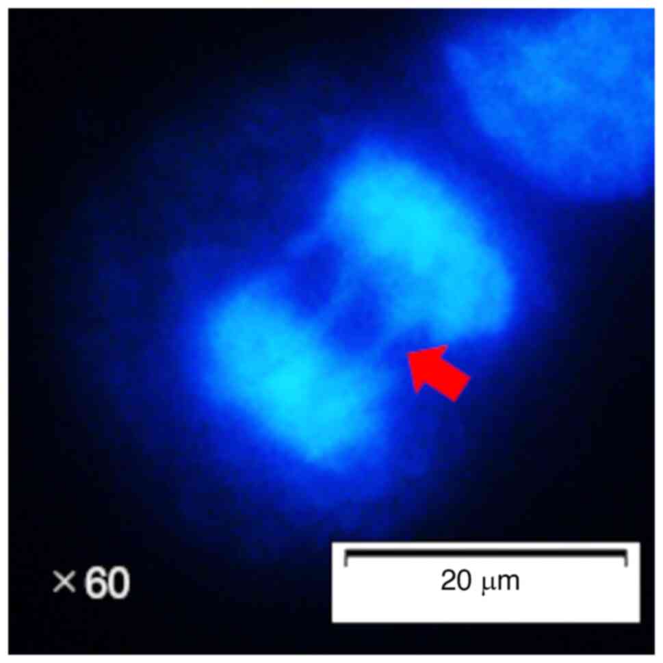 Representative image of lagging
chromosomes in NCI-N87 cells. Chromosomes remained on the metaphase
plate and formed bridges in anaphase (red arrow).