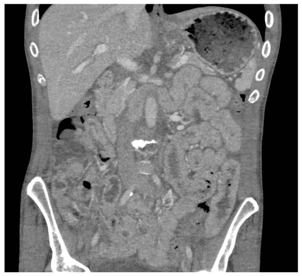 Computed tomography scan of the
abdomen/pelvis with contrast illustrating diffuse intramural
thickening of the colon identified in the sigmoid region; this may
represent sequelae of colitis. Additionally, diffuse intramural
thickening of the small bowel loops was noted.