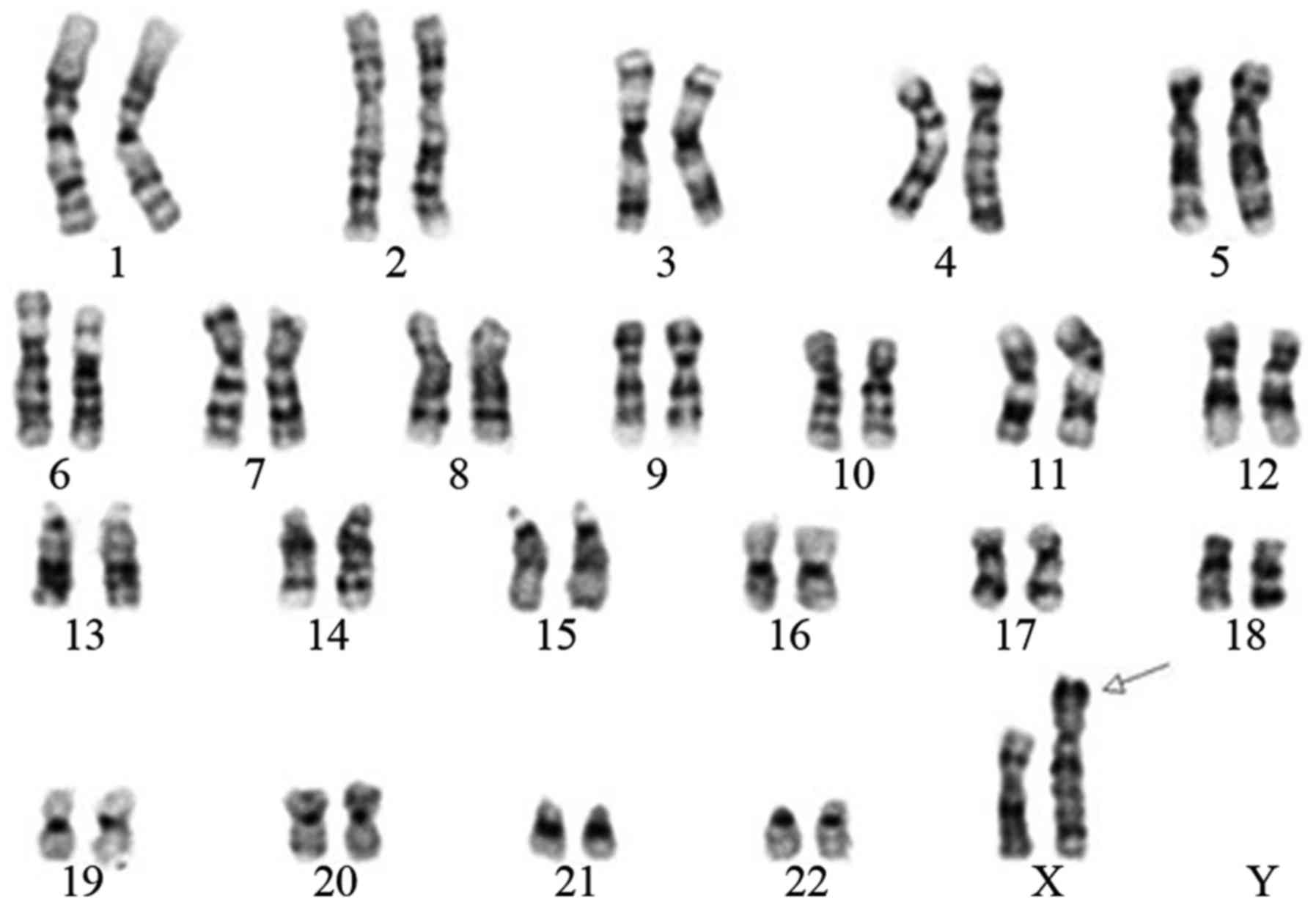 Prenatal Diagnosis Of Sex Chromosomal Inversion Translocation And Deletion