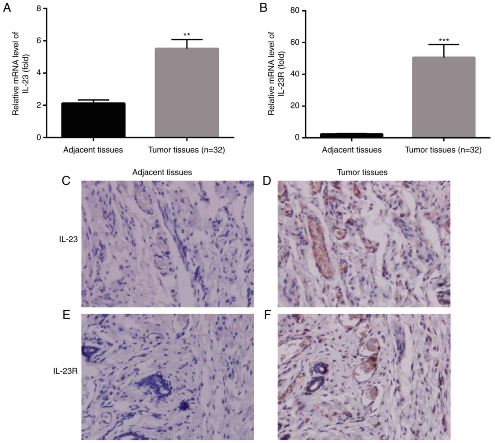 Aberrant Expression Of Il 23 Il 23r In Patients With Breast Cancer And Its Clinical Significance