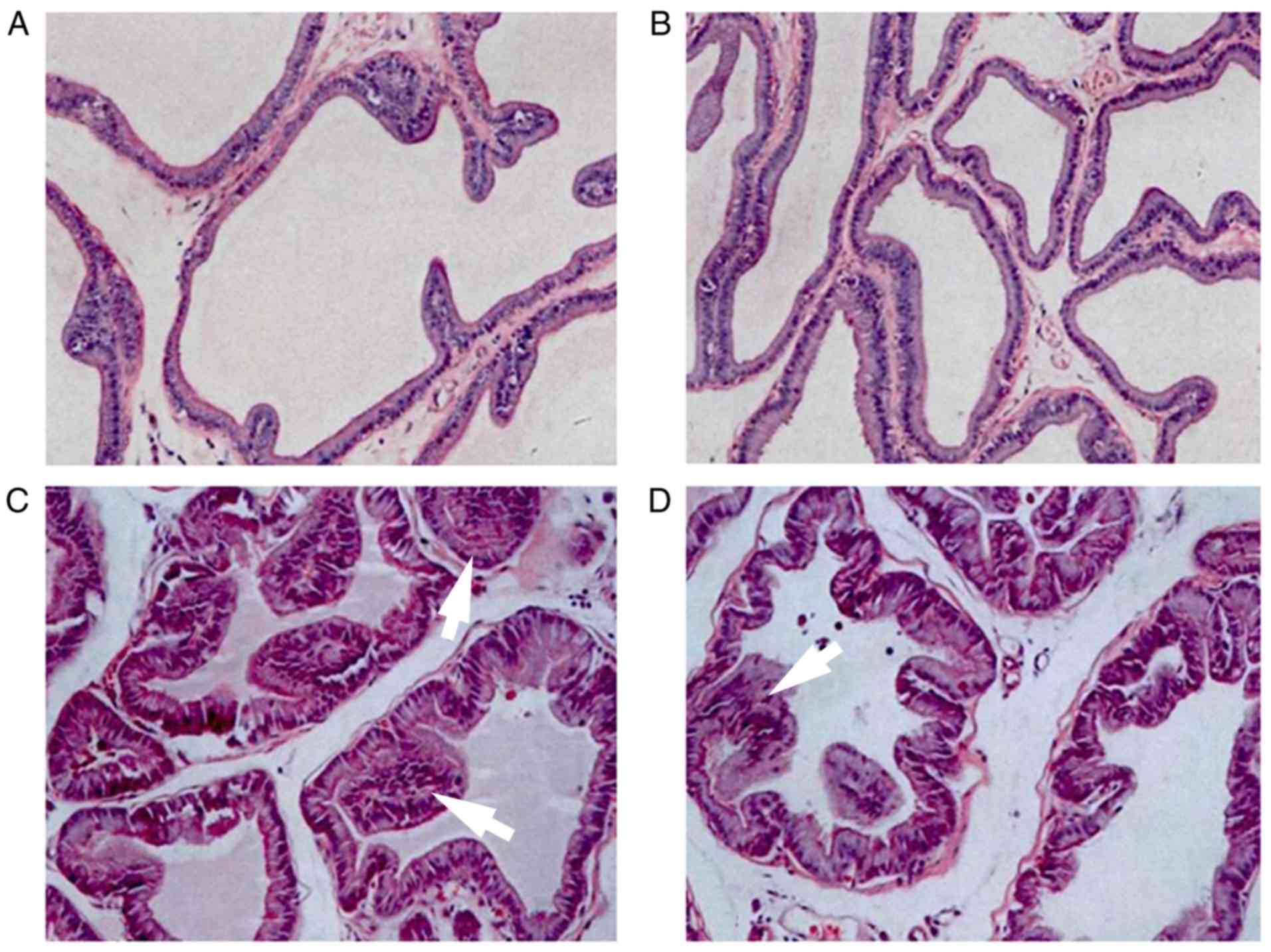 nonbacterial prostatitis and alcohol