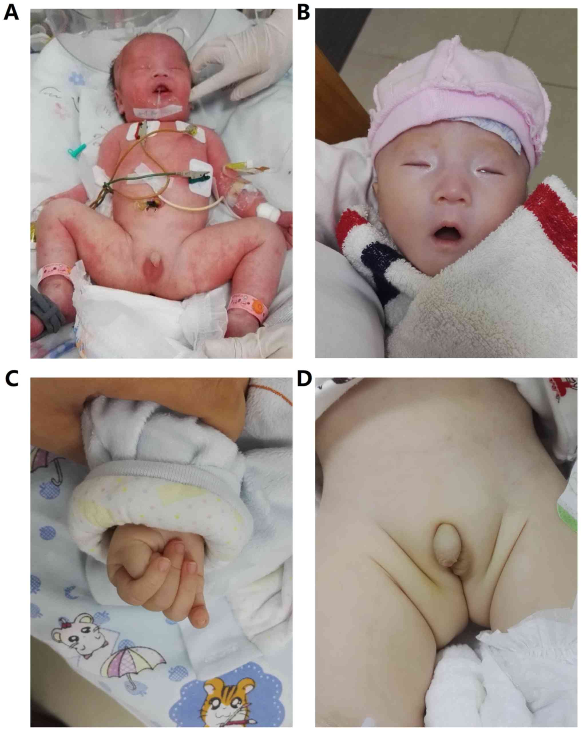 Small hands characteristic of Prader-Willi syndrome.