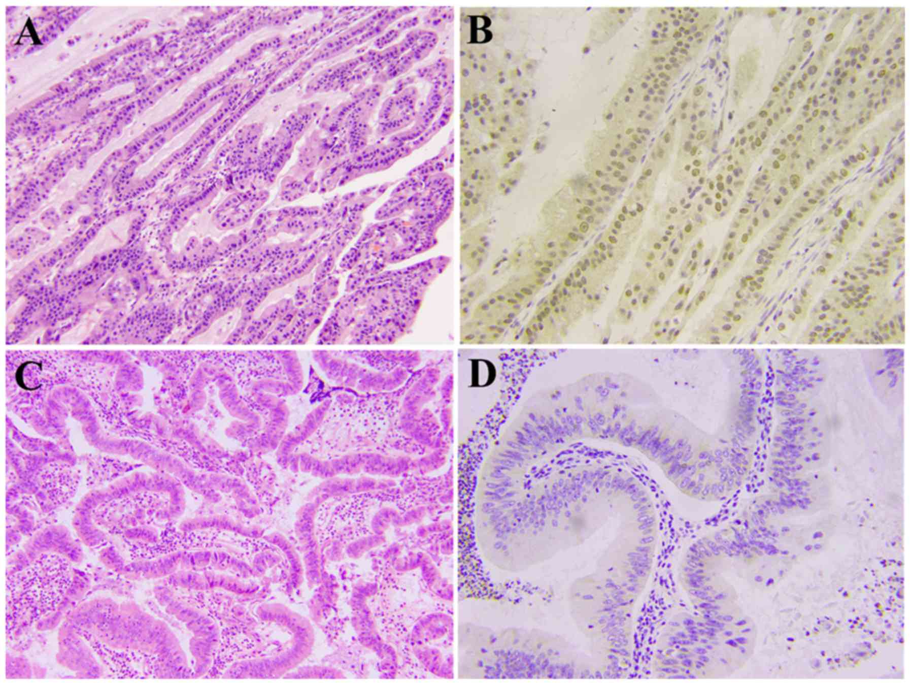 MPZL1 is highly expressed in advanced gallbladder carcinoma and 