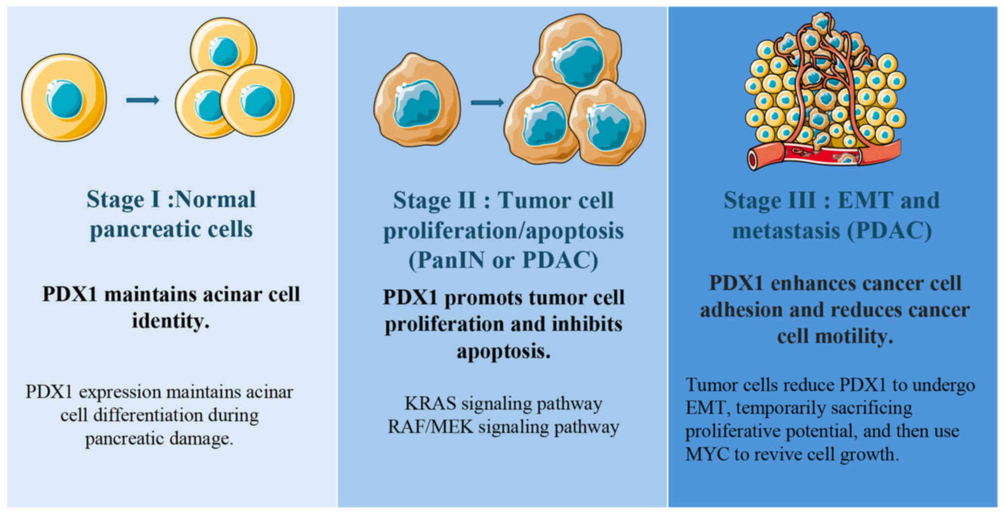 The differing effect of PDX1 on
tumorigenesis across various stages. PDX1, pancreatic and duodenal
homeobox gene 1; PDAC, pancreatic ductal adenocarcinomas; RAF, Raf
protein kinase; MEK, mitogen-activated extracellular
signal-regulated kinase; EMT, epithelial-mesenchymal transition;
MYC, myelocytomatosis oncogene.