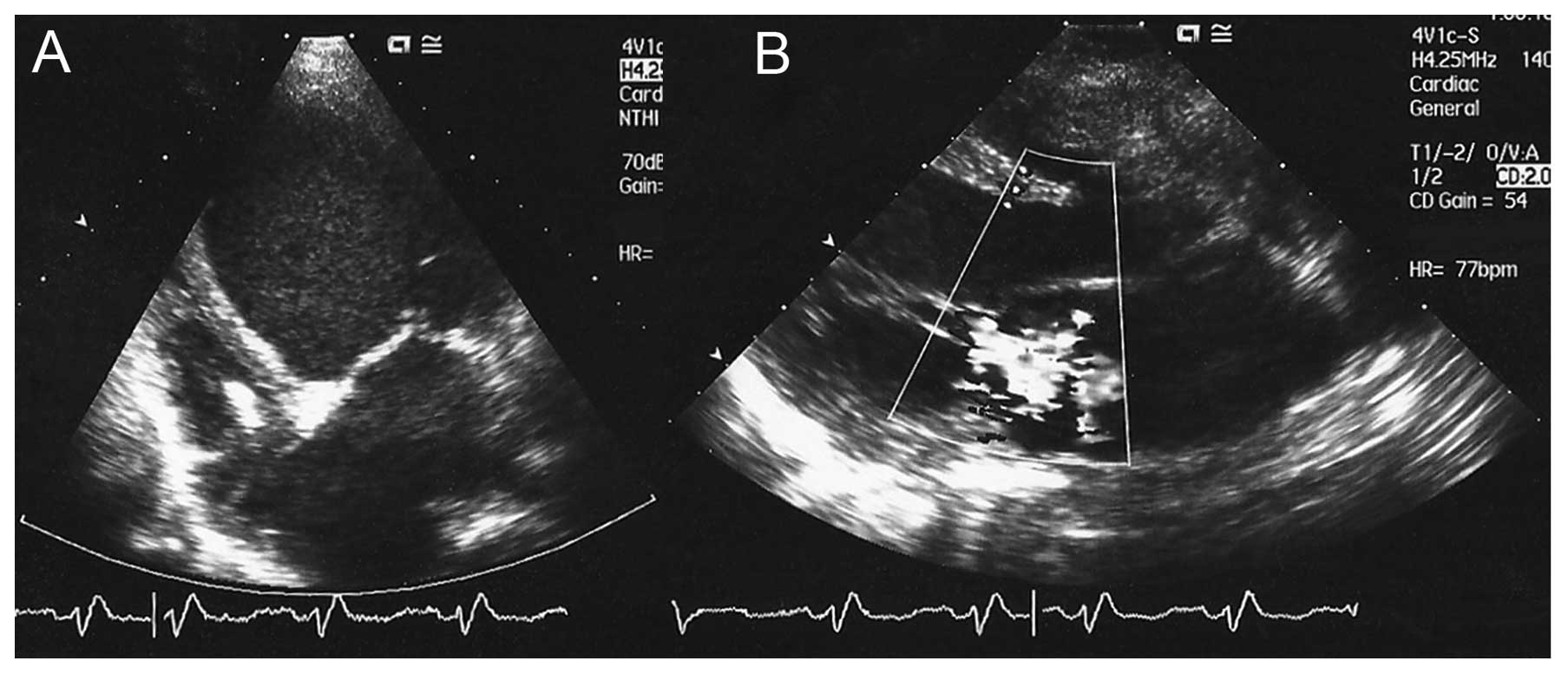 Dilated cardiomyopathy and ovarian dysgenesis in a patient with Malouf syndrome: A case report