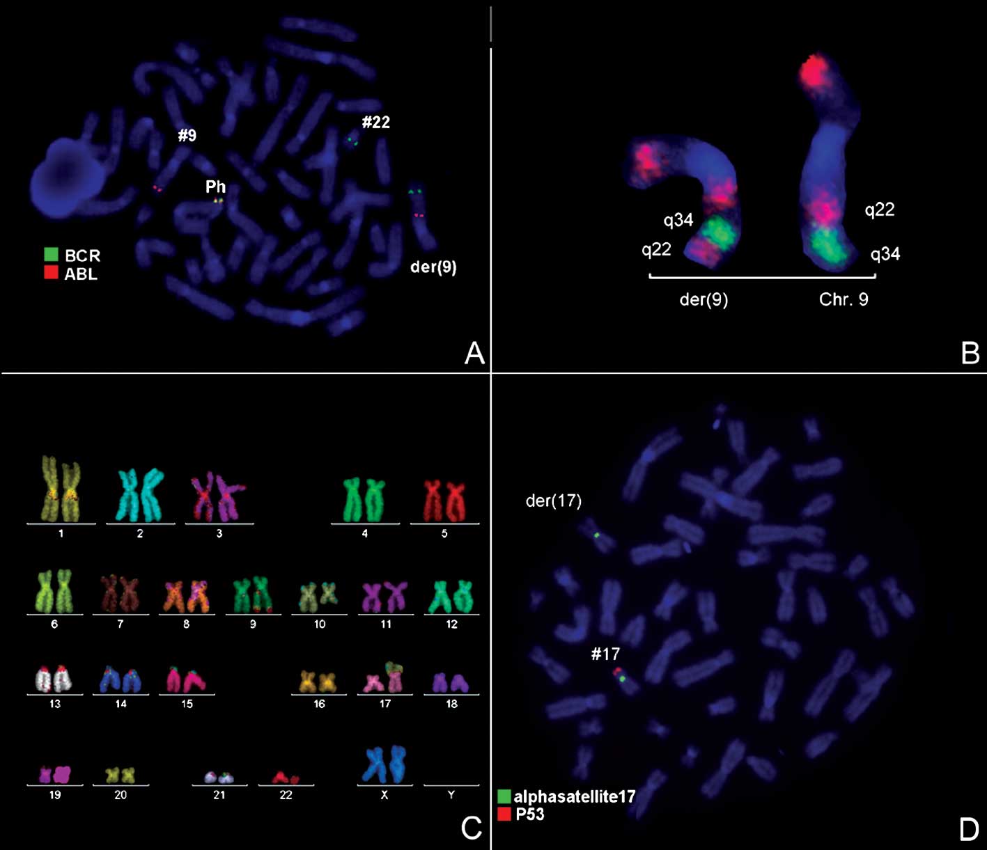 Фото трипло. Филадельфийская хромосома кариотип. Флуоресцентная окраска хромосом. Fish окрашивание хромосом. Флуоресцентное окрашивание хромосом.