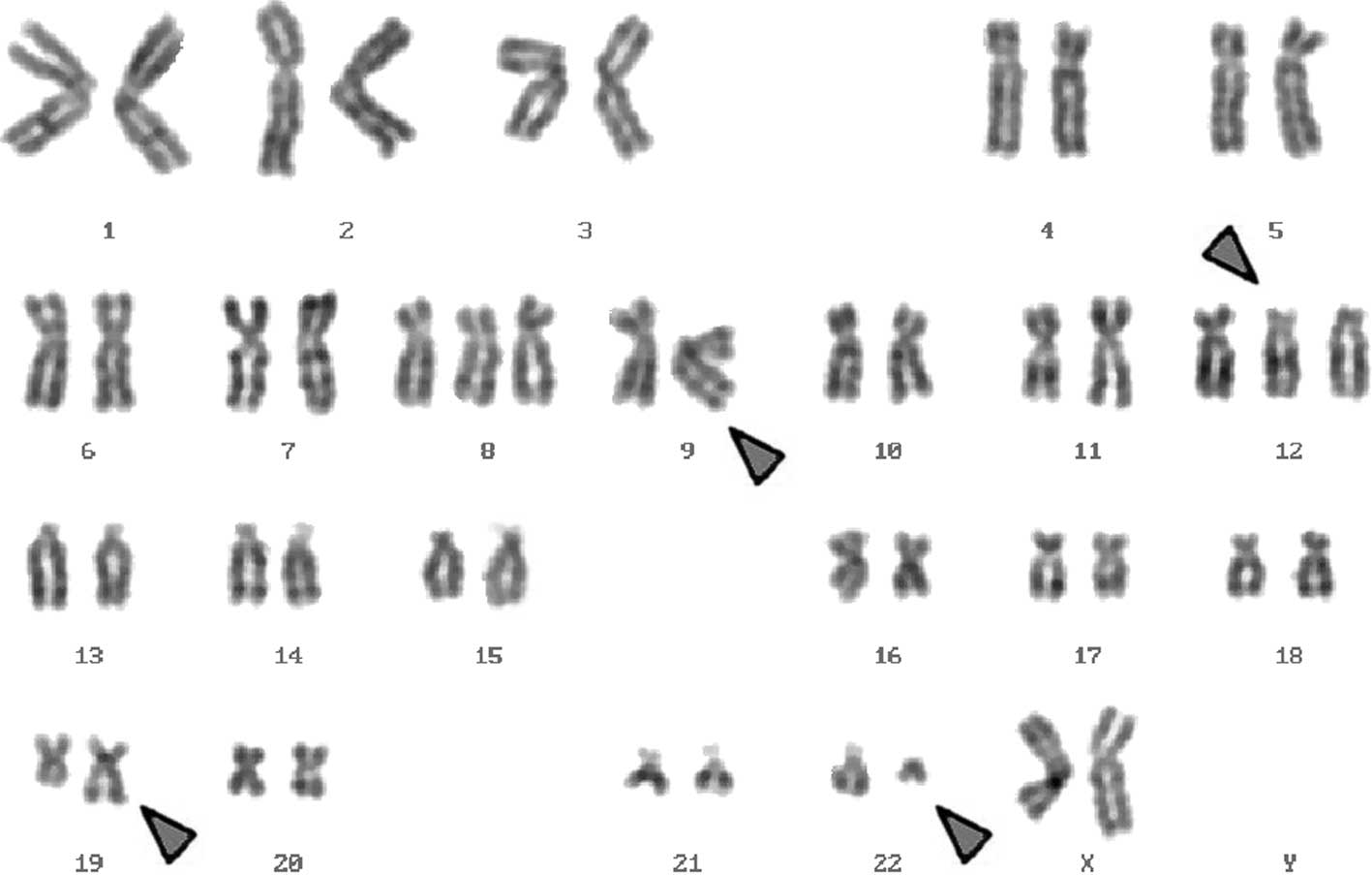 Пересадка хромосом. Филадельфийская хромосома кариотип. Транслокация кариотип. Синдром Клайнфельтера кариотип. Транслокация хромосом кариотип.