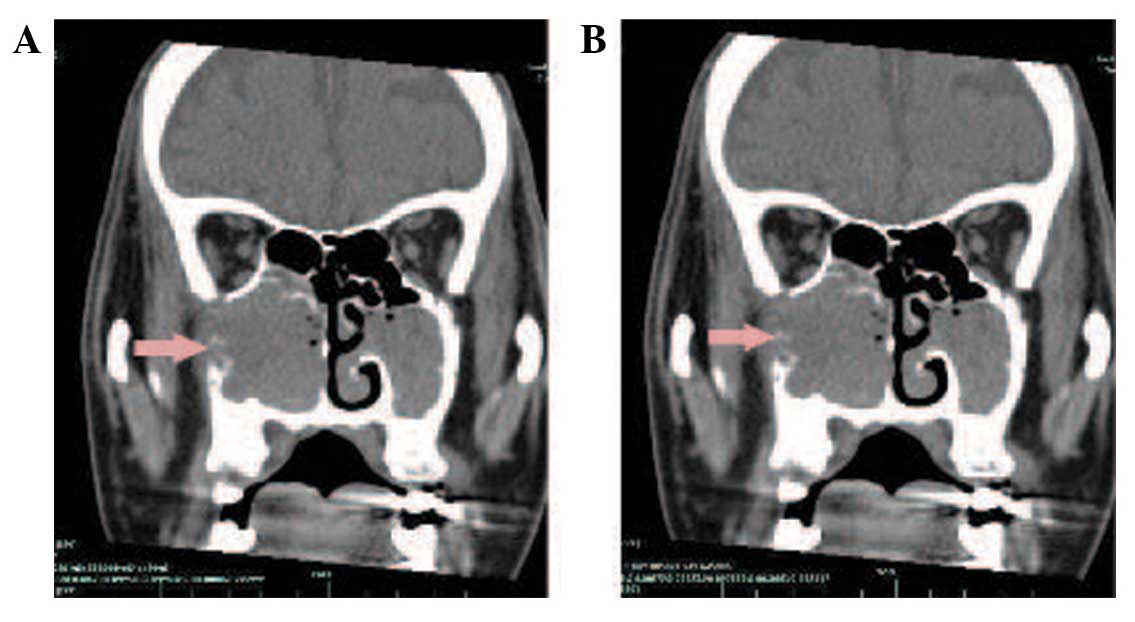 papilloma sinus inverted human papillomavirus throat cancer