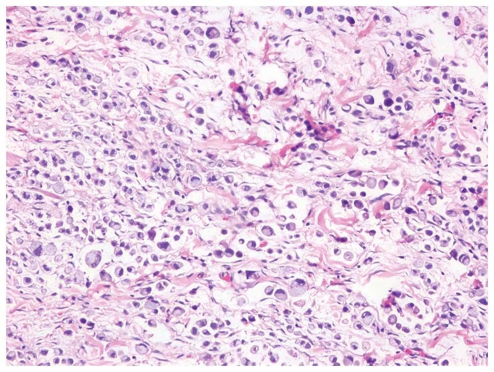 Histological transformation to signet-ring cell carcinoma in a patient with  clinically aggressive poorly differentiated adenocarcinoma of the ascending  colon after response to chemotherapy plus cetuximab: a case report | World  Journal of