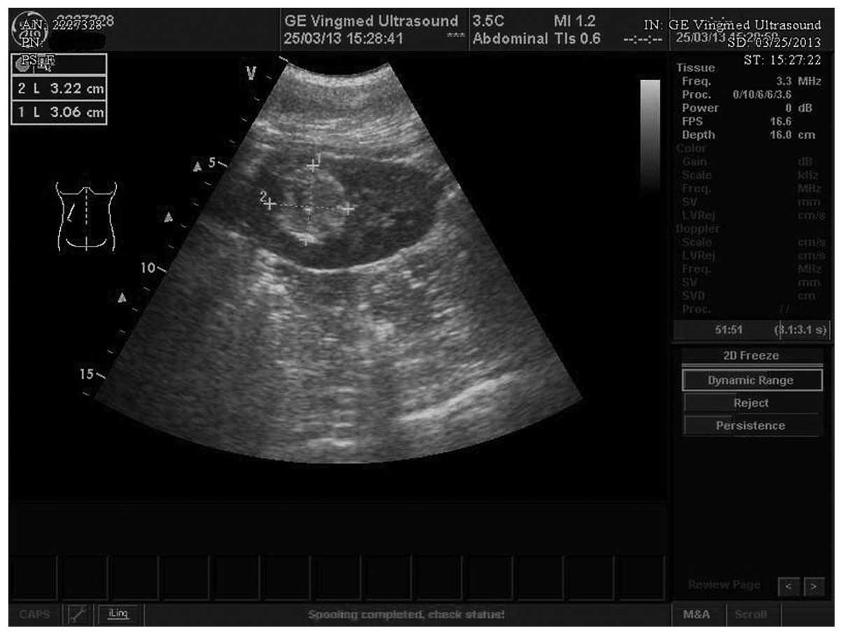 Renal Adenoma Ultrasound