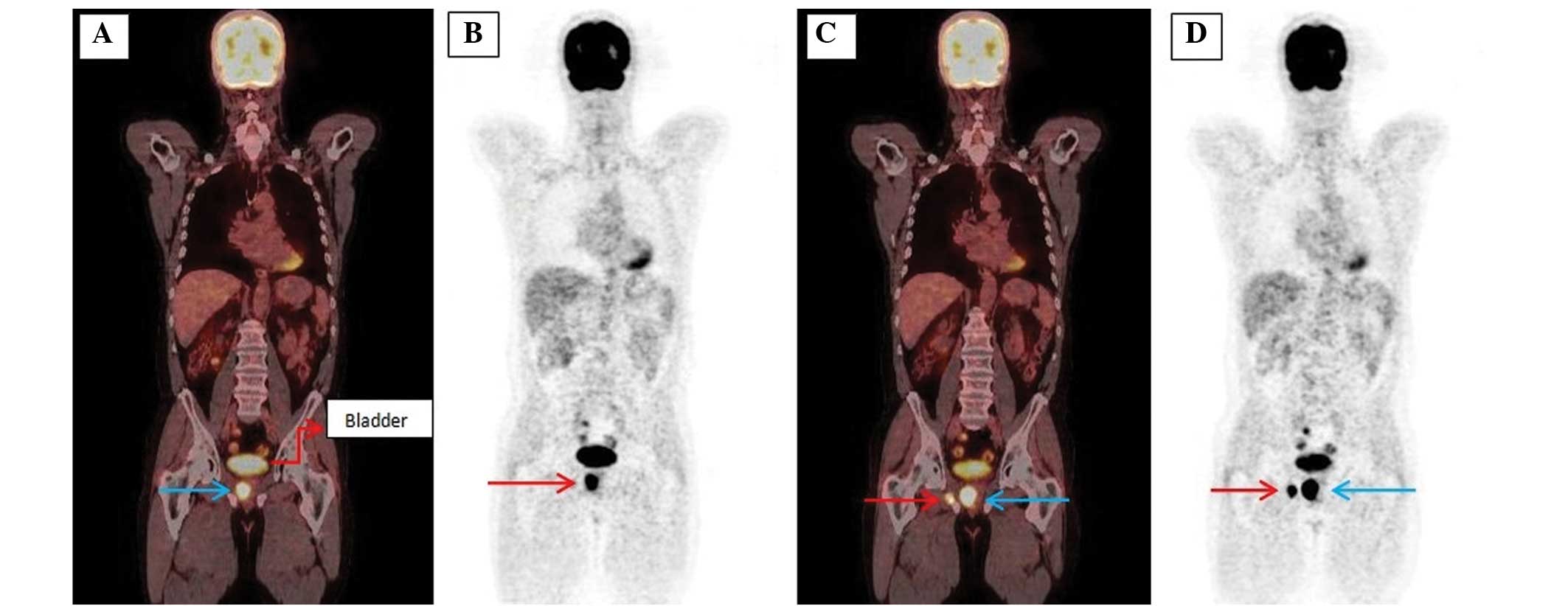 18f Fluorodeoxyglucose Petct For Detection Of Disease In Patients With