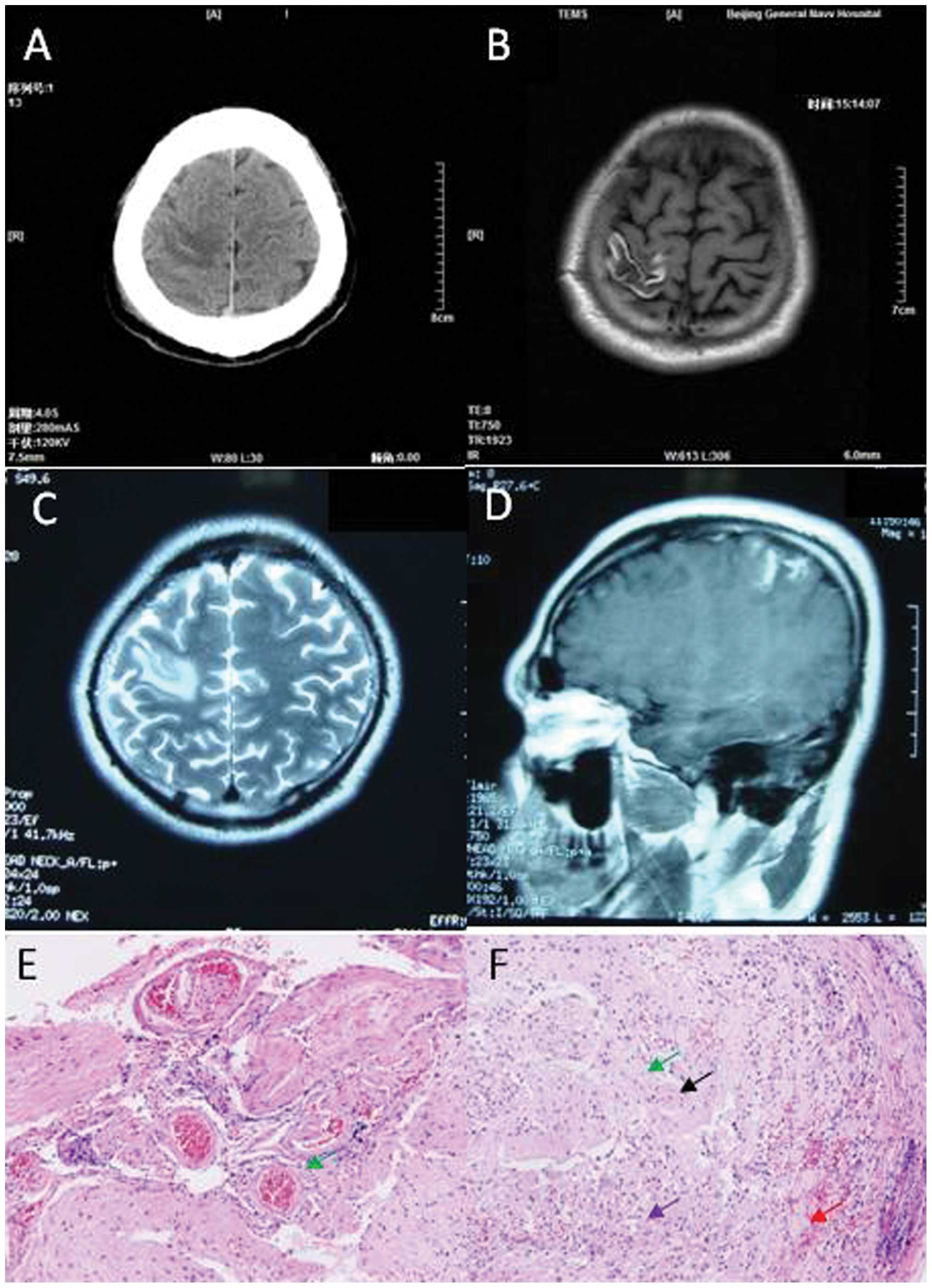 cortical vein thrombosis