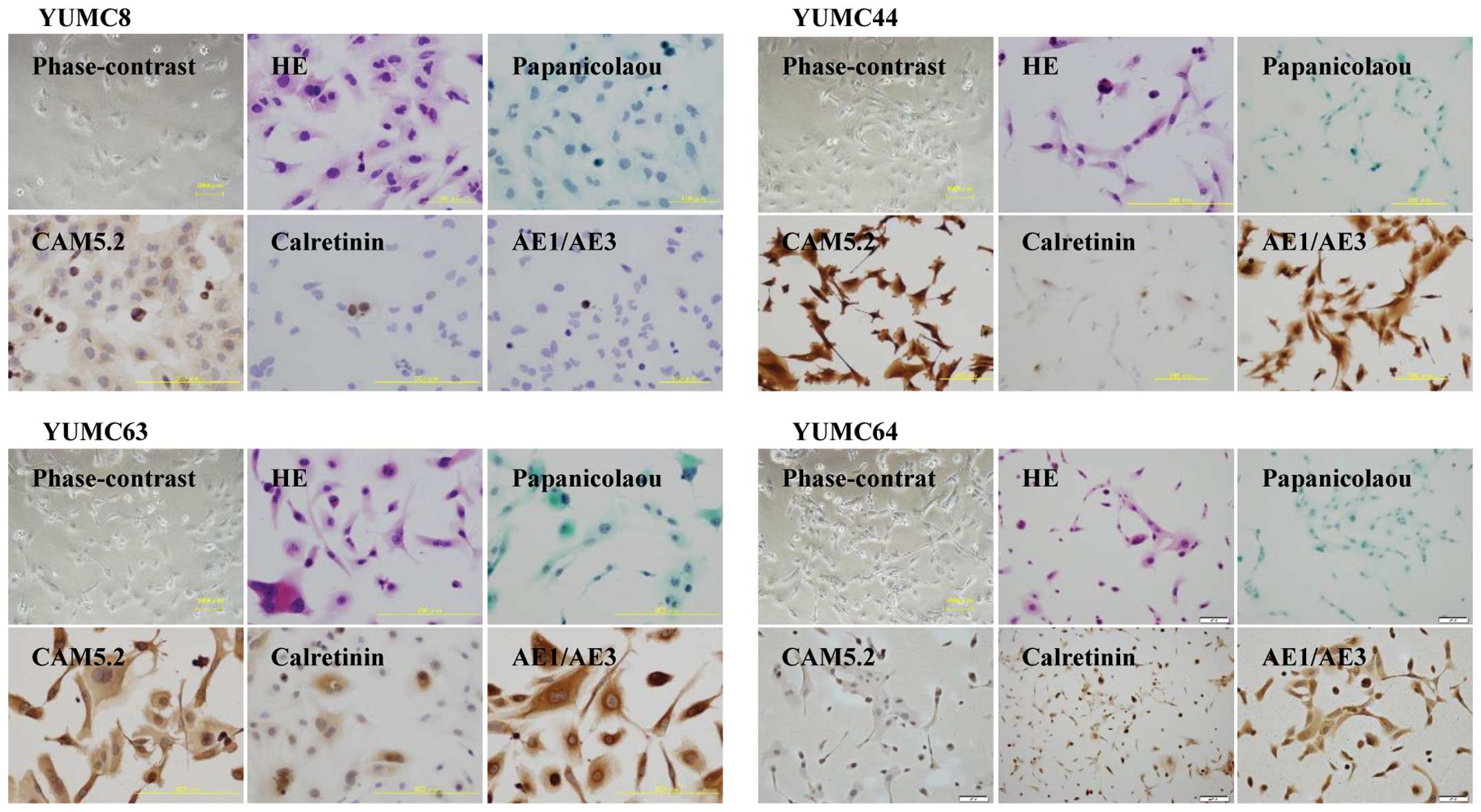 mesothelioma associated with exposure