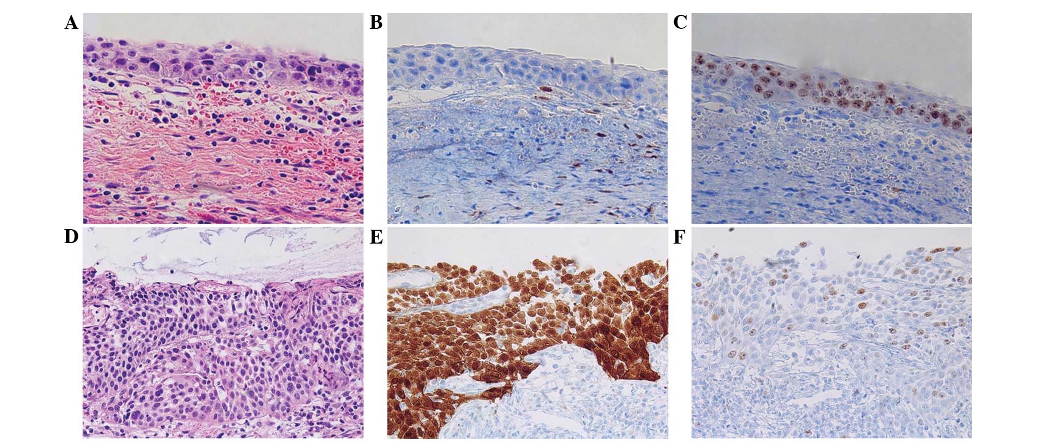 Wiley Encyclopedia of Molecular Medicine, 5 Volume Set Human papillomavirus p16 staining