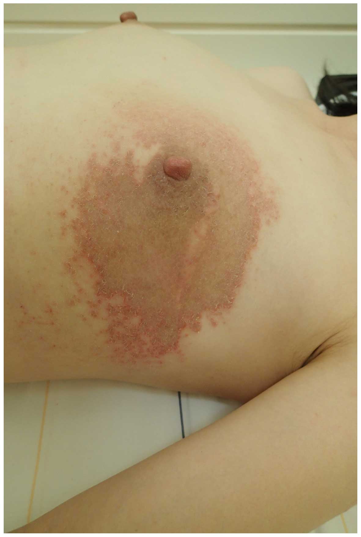 Red circle under breast. Slight burning. Been here for 3 days. :  r/DermatologyQuestions