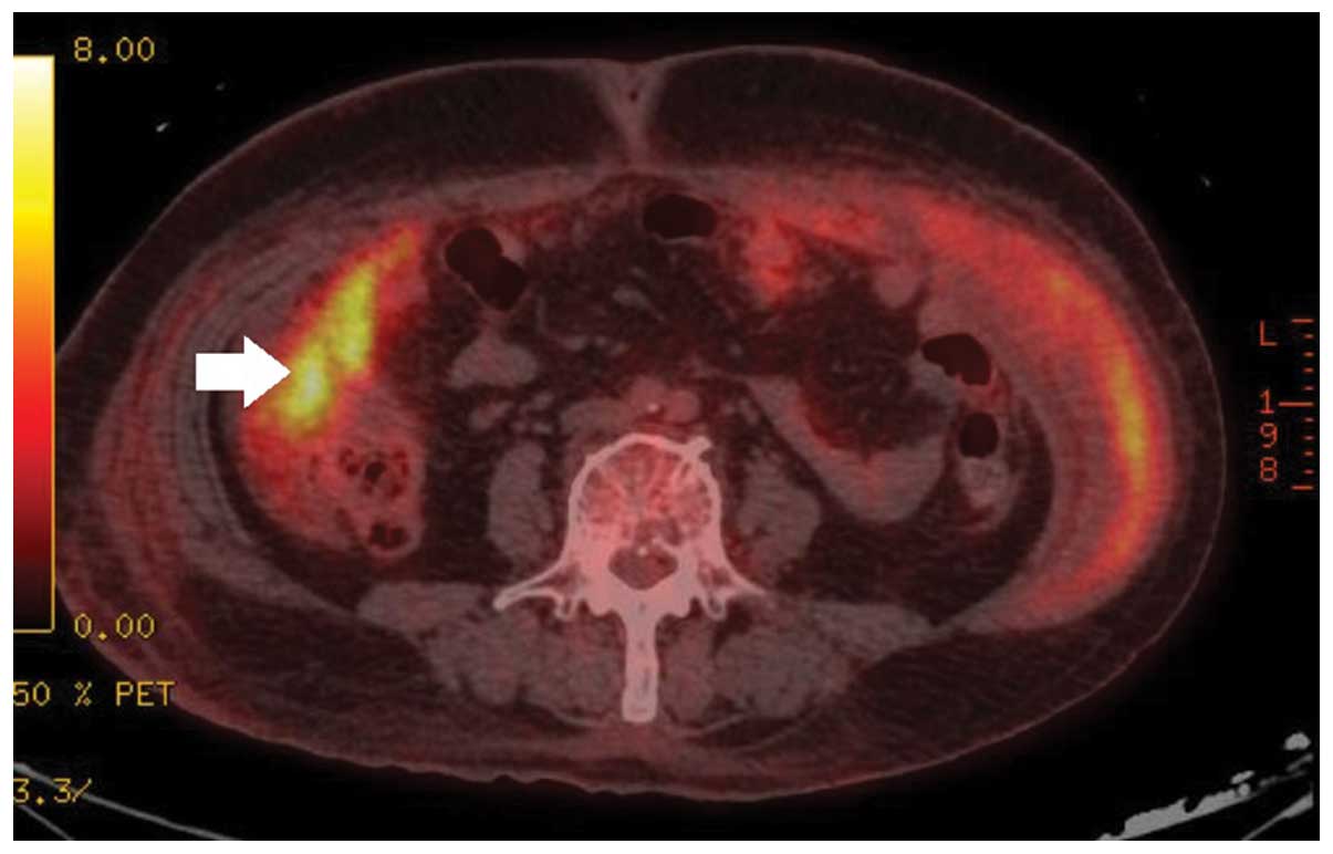 peritoneal cancer pet scan)