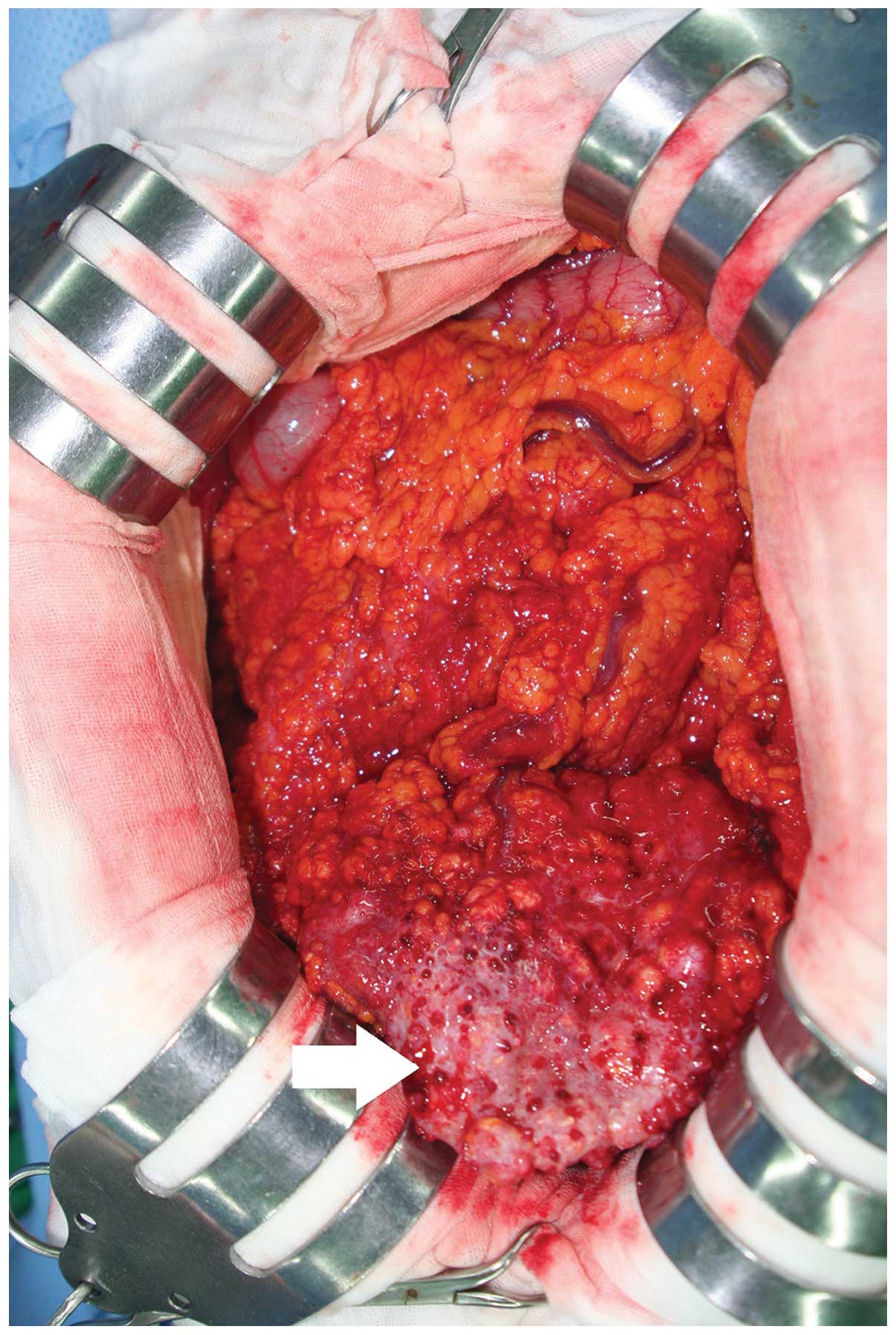 Primary peritoneal serous carcinoma, an extremely rare malignancy: A case report and review of 