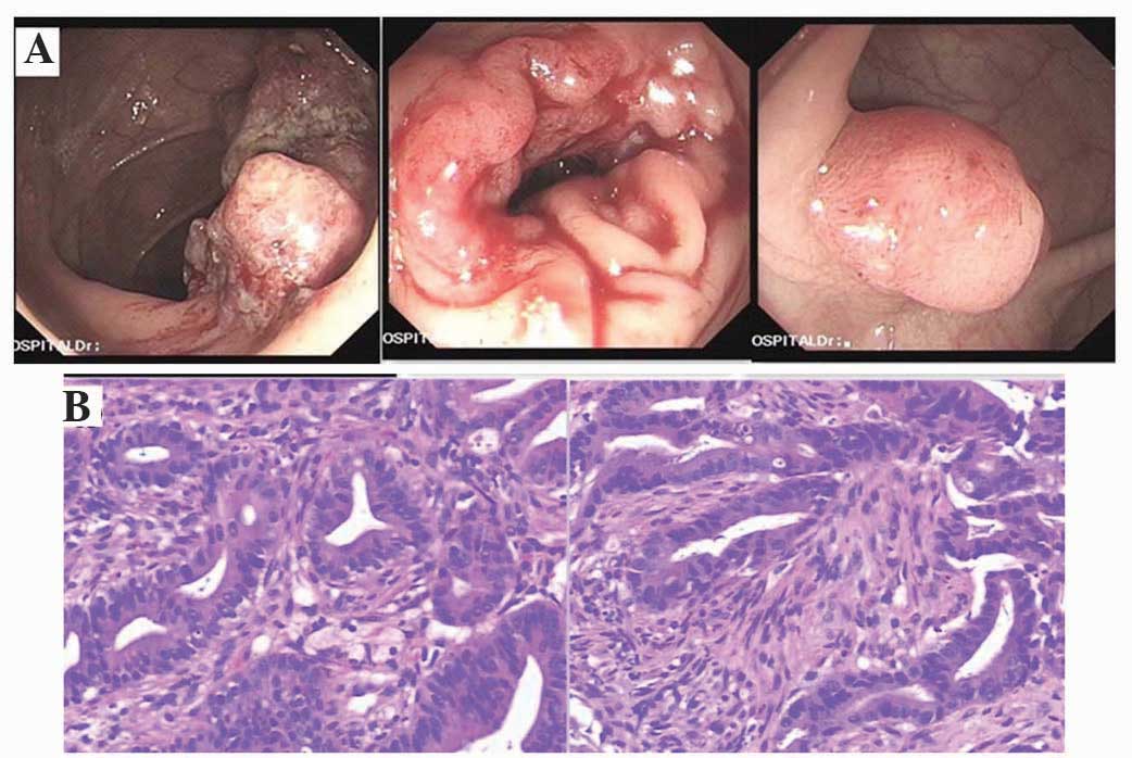 bowel cancer hepatic flexure