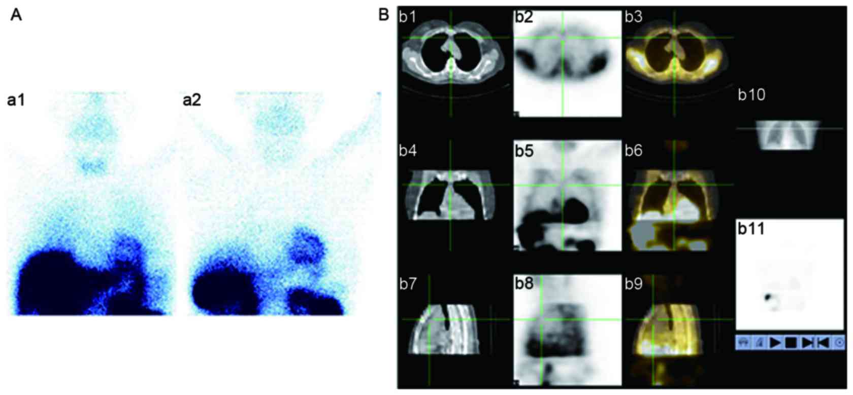 Application values of 99mTc‑methoxyisobutylisonitrile imaging for .