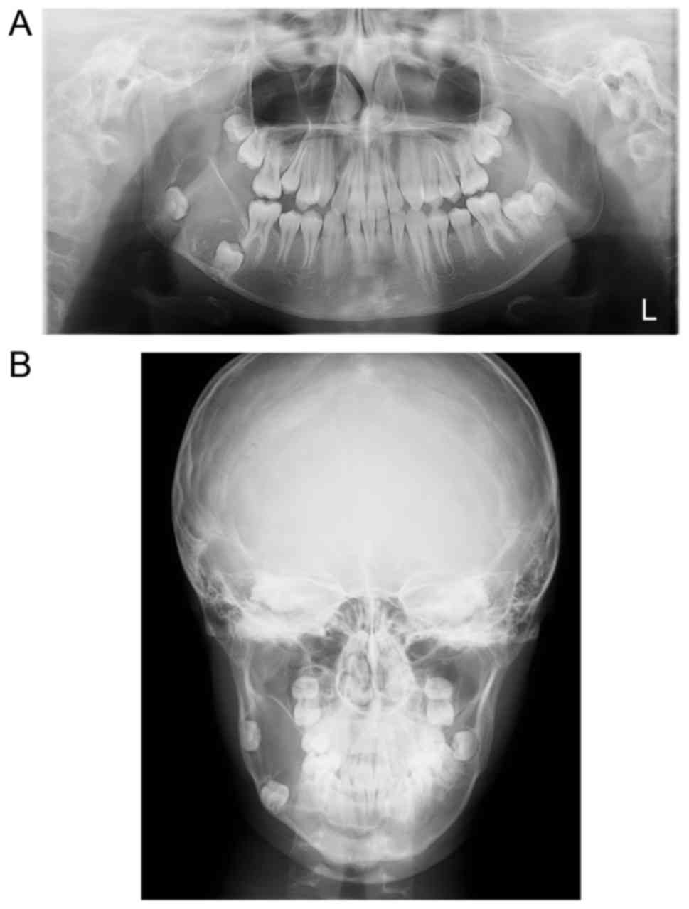 calcifying odontogenic cyst radiographic