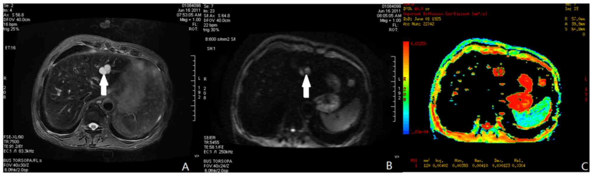 ADC values (mm2/s) of tumor and liver at different time points.