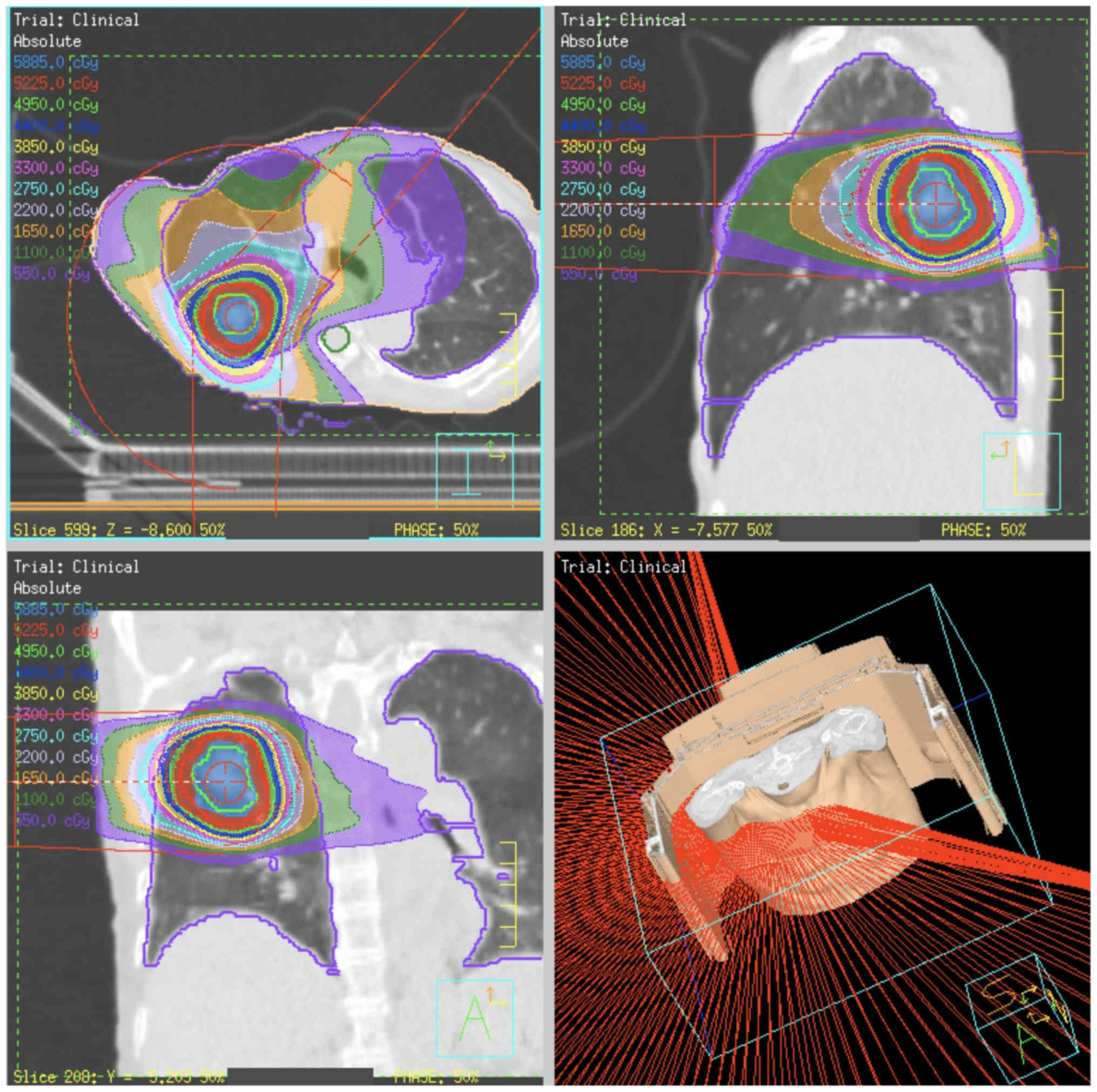 Sbrt Sexy - Flattening filter-free technique in volumetric modulated arc therapy for  lung stereotactic body radiotherapy: A clinical comparison with the  flattening filter technique