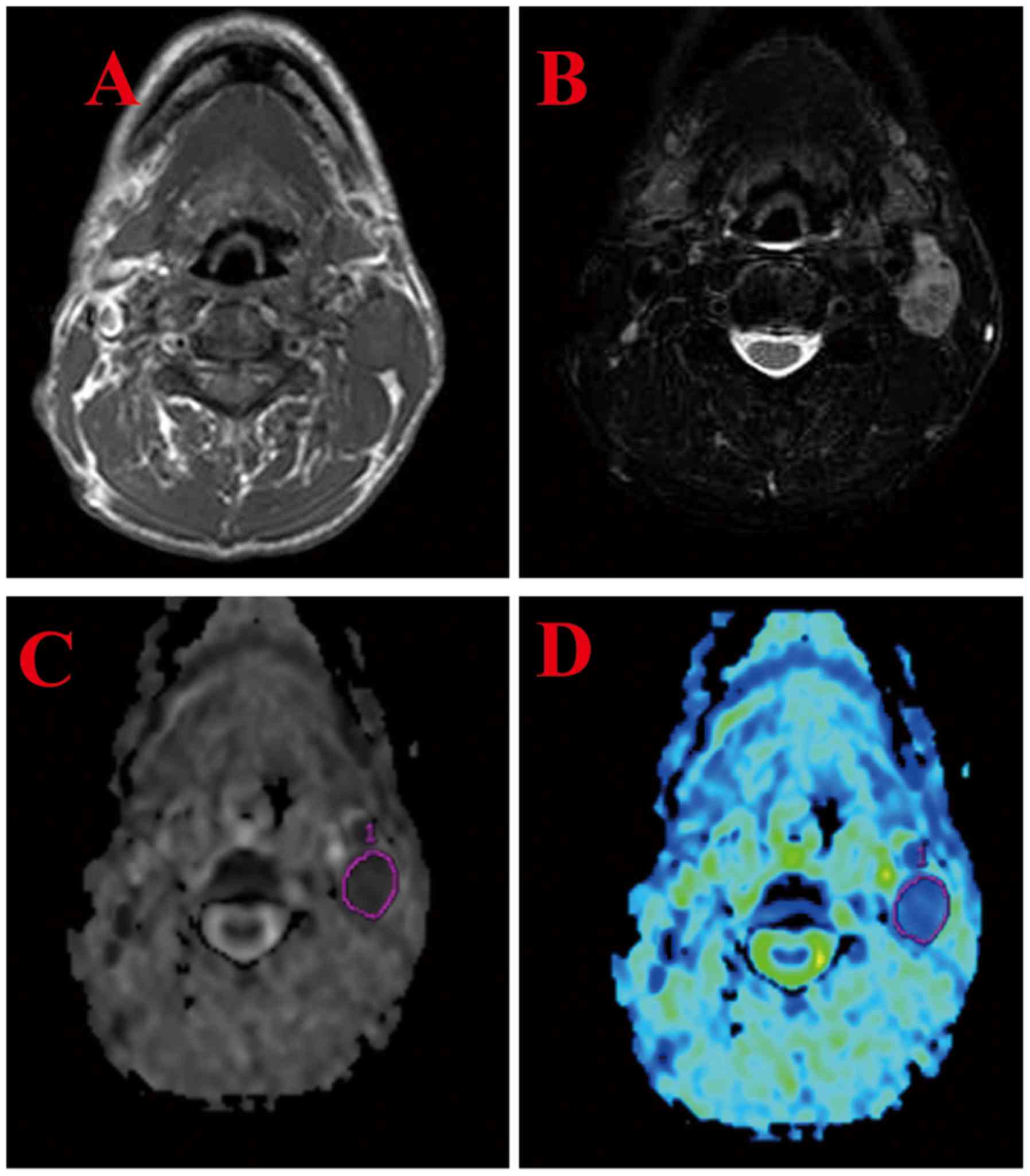 The Diagnostic Role Of Diffusion Weighted Magnetic Resonance Imaging In