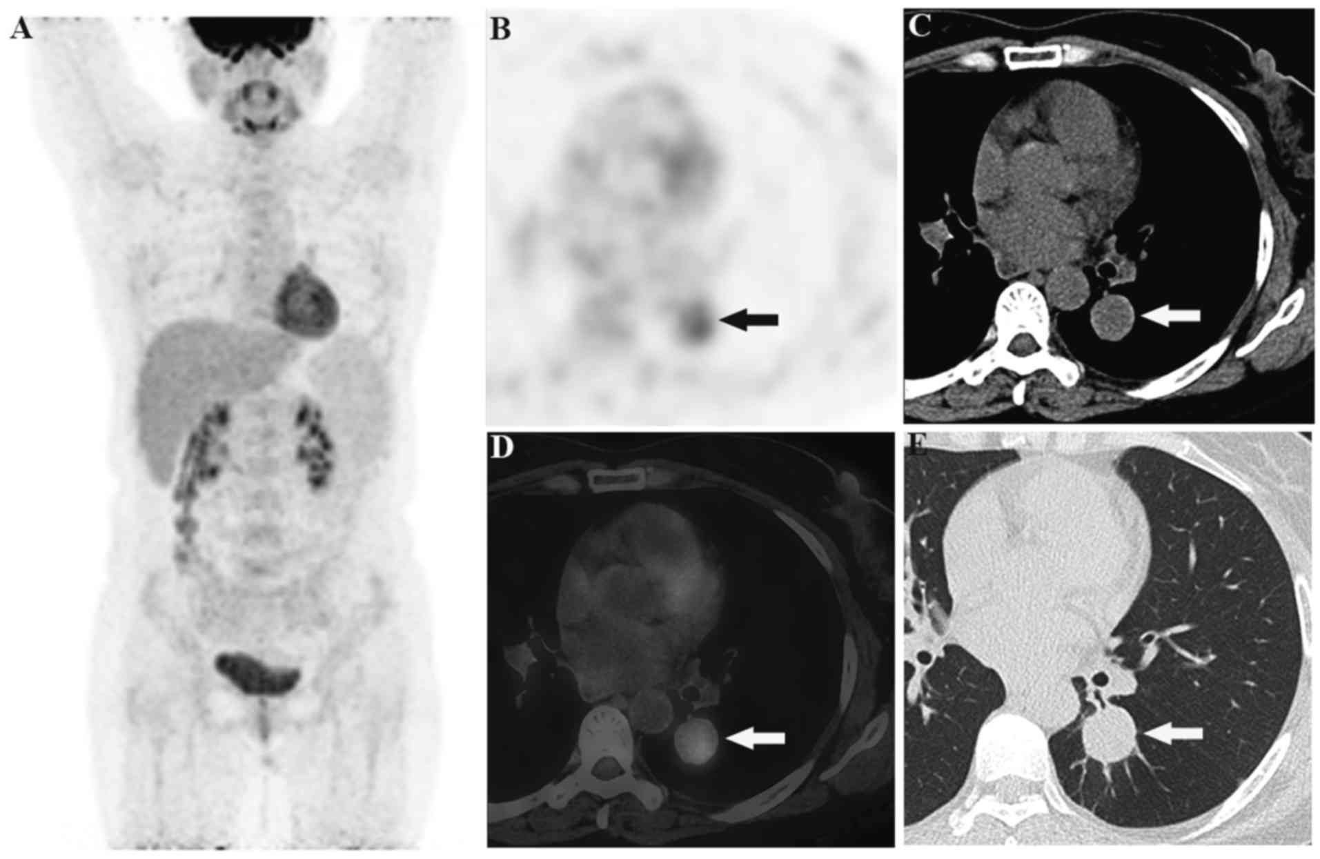 what is squamous cell carcinoma of the mouth