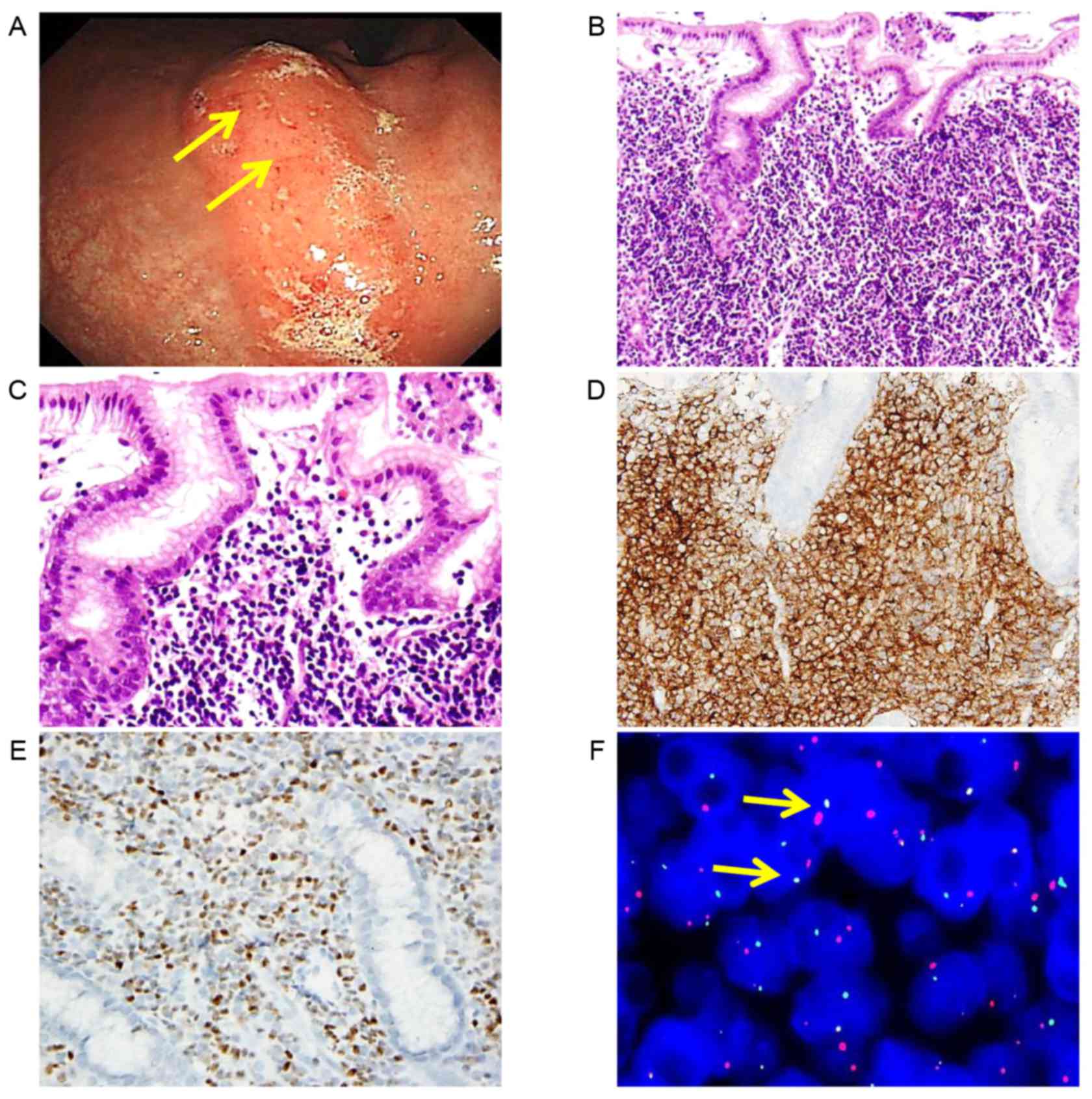 Gastric Follicular Lymphoma A Report Of 3 Cases And A Review Of The