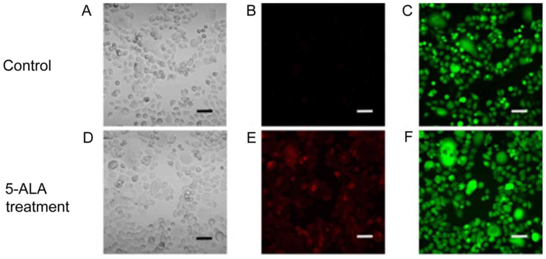 Photodynamic Diagnosis Of Peritoneal Metastasis In Human Pancreatic Cancer Using 5 Aminolevulinic Acid During Staging Laparoscopy
