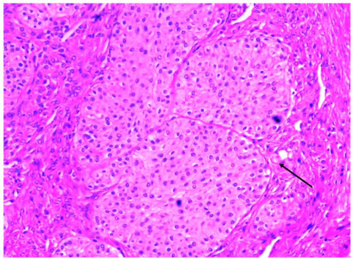 Figure 3. - Pathological analysis of a case of ovarian Brenner tumor. 
