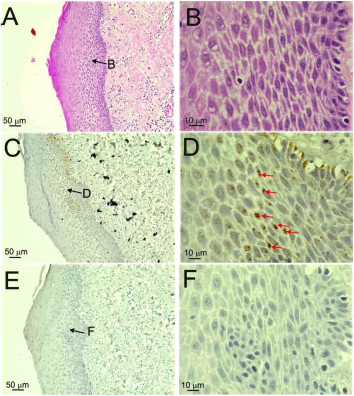 humán papillomavírus in situ hibridizáció papilloma anlam nedir