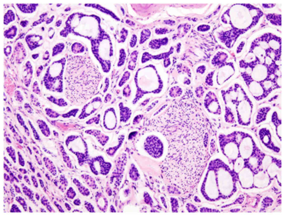 adenoid cystic carcinoma pathology mellékvese adenoma