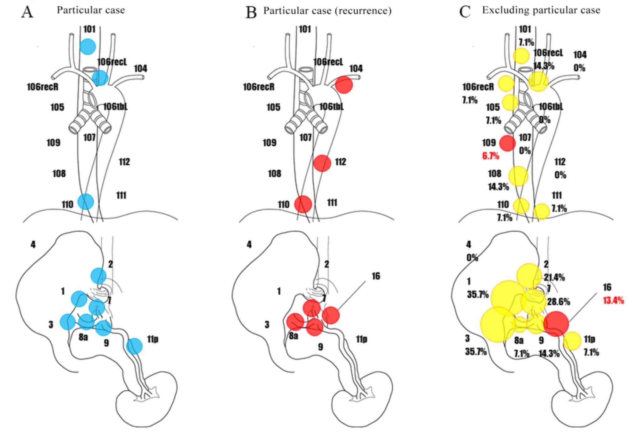 Stages Of Cancer Lymph Node