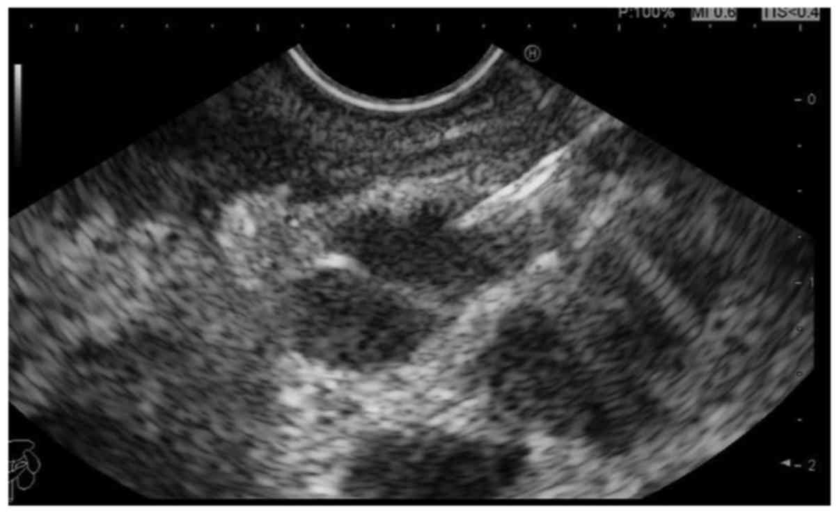 Endoscopic ultrasound‑guided fine‑needle aspiration biopsy for
