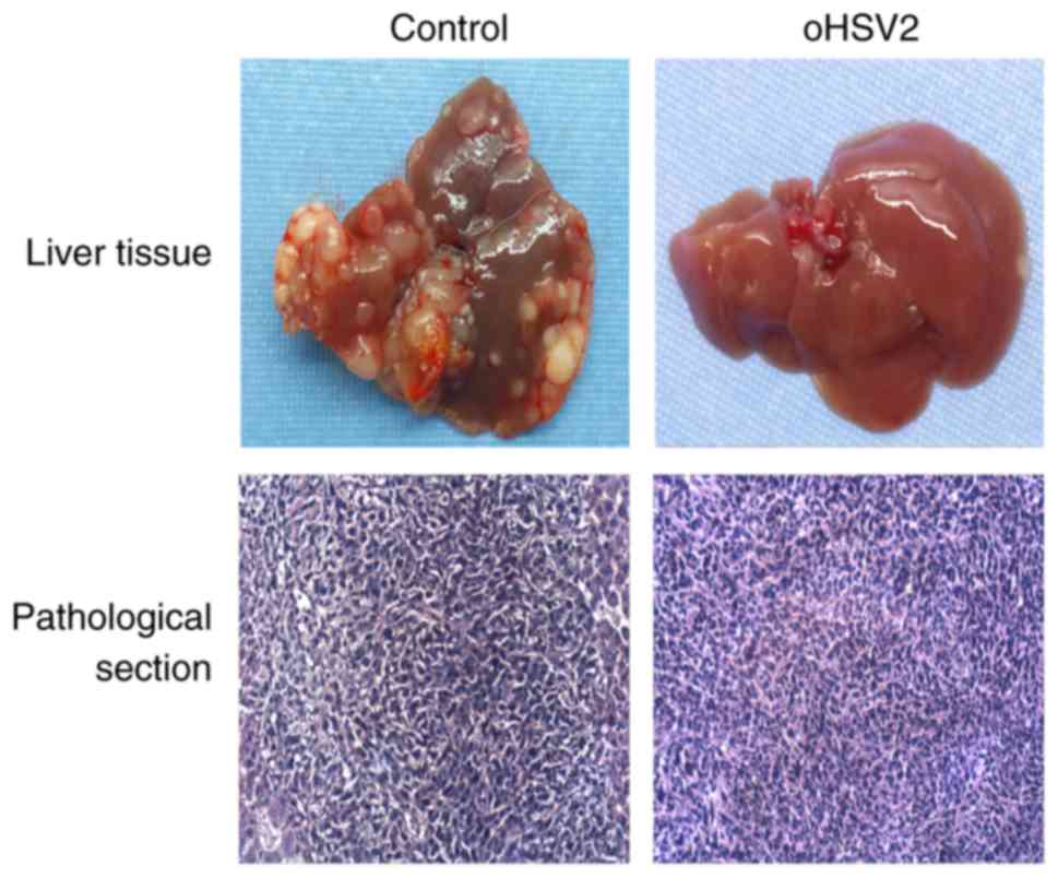 Inhibition Of Colorectal Cancer Liver Metastasis In Balb C Mice Following Intratumoral Injection