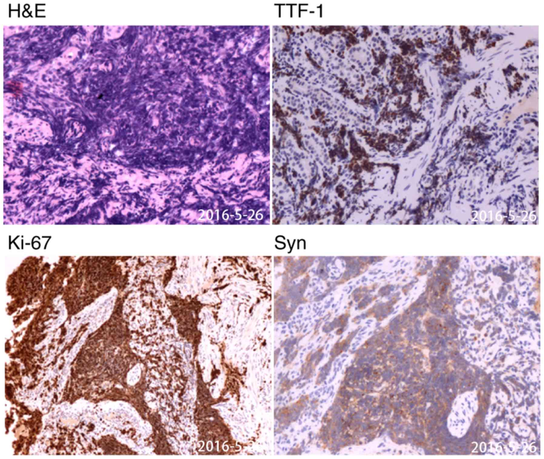 treatment of malignant mesothelioma telegra ph