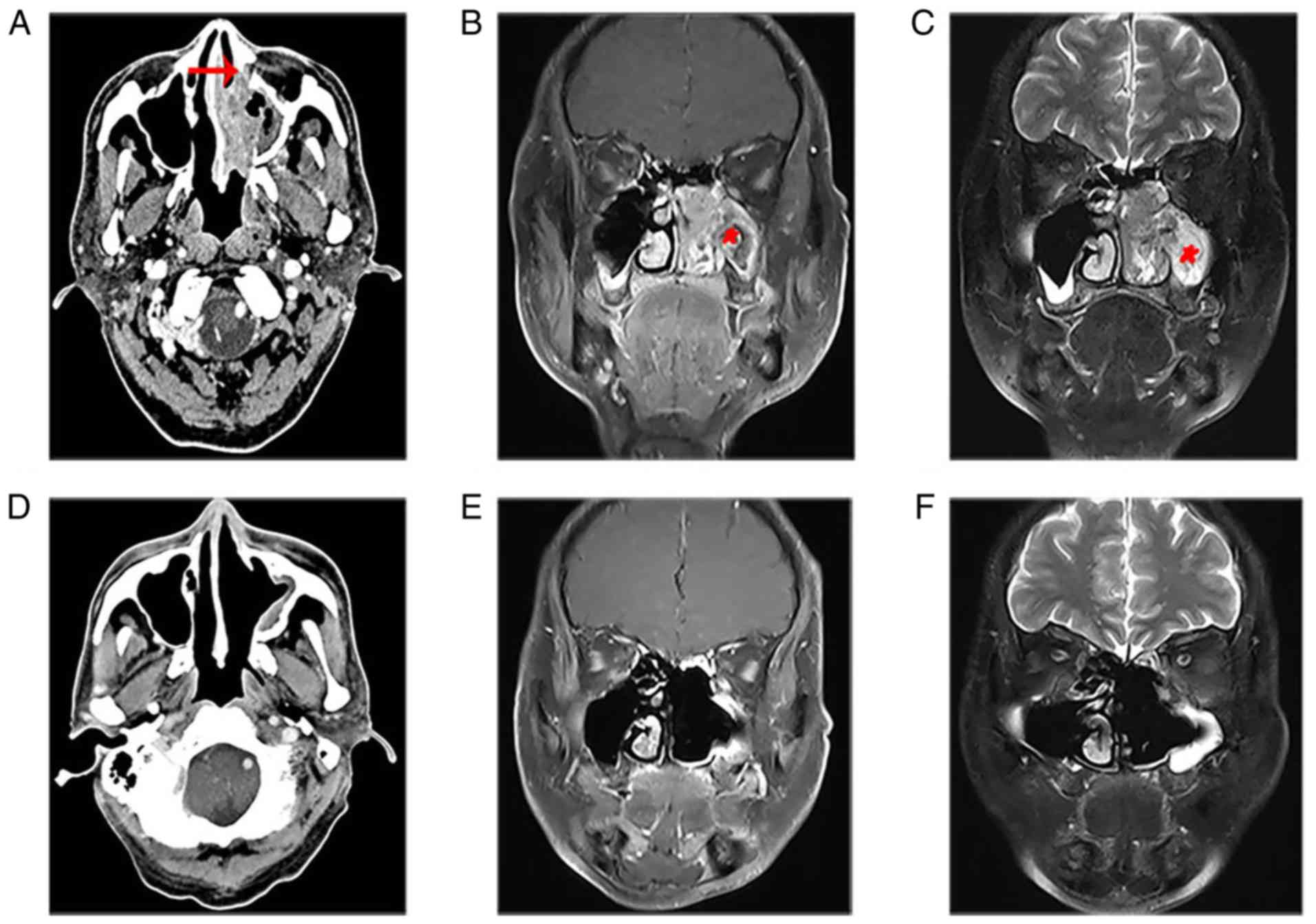 papilloma sinus mri)