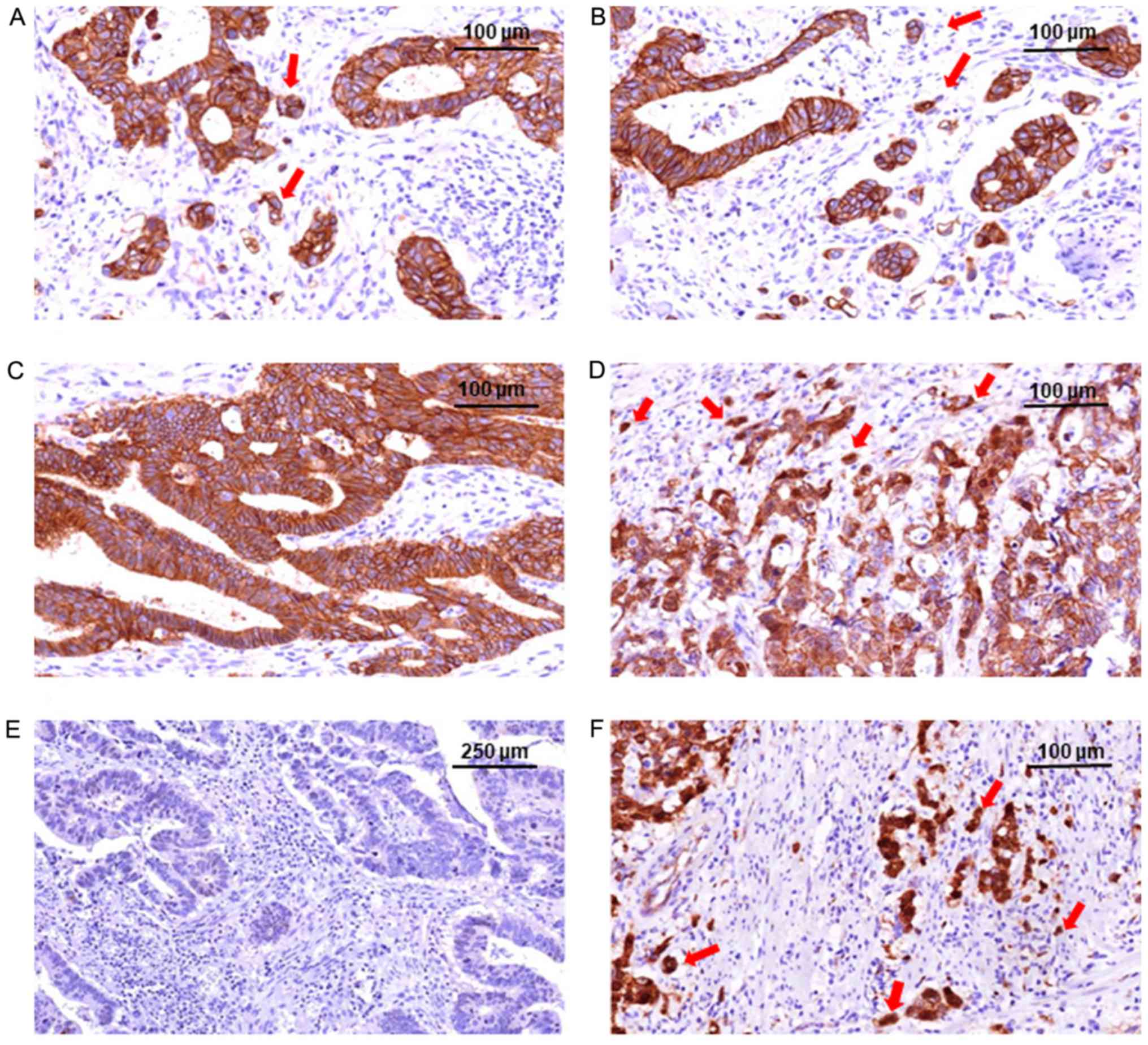 urinary bladder cancer and asbestos exposure