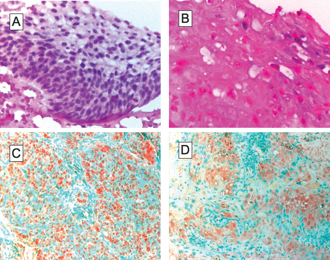 human papillomavirus in situ hybridization ovarian cancer nutrition